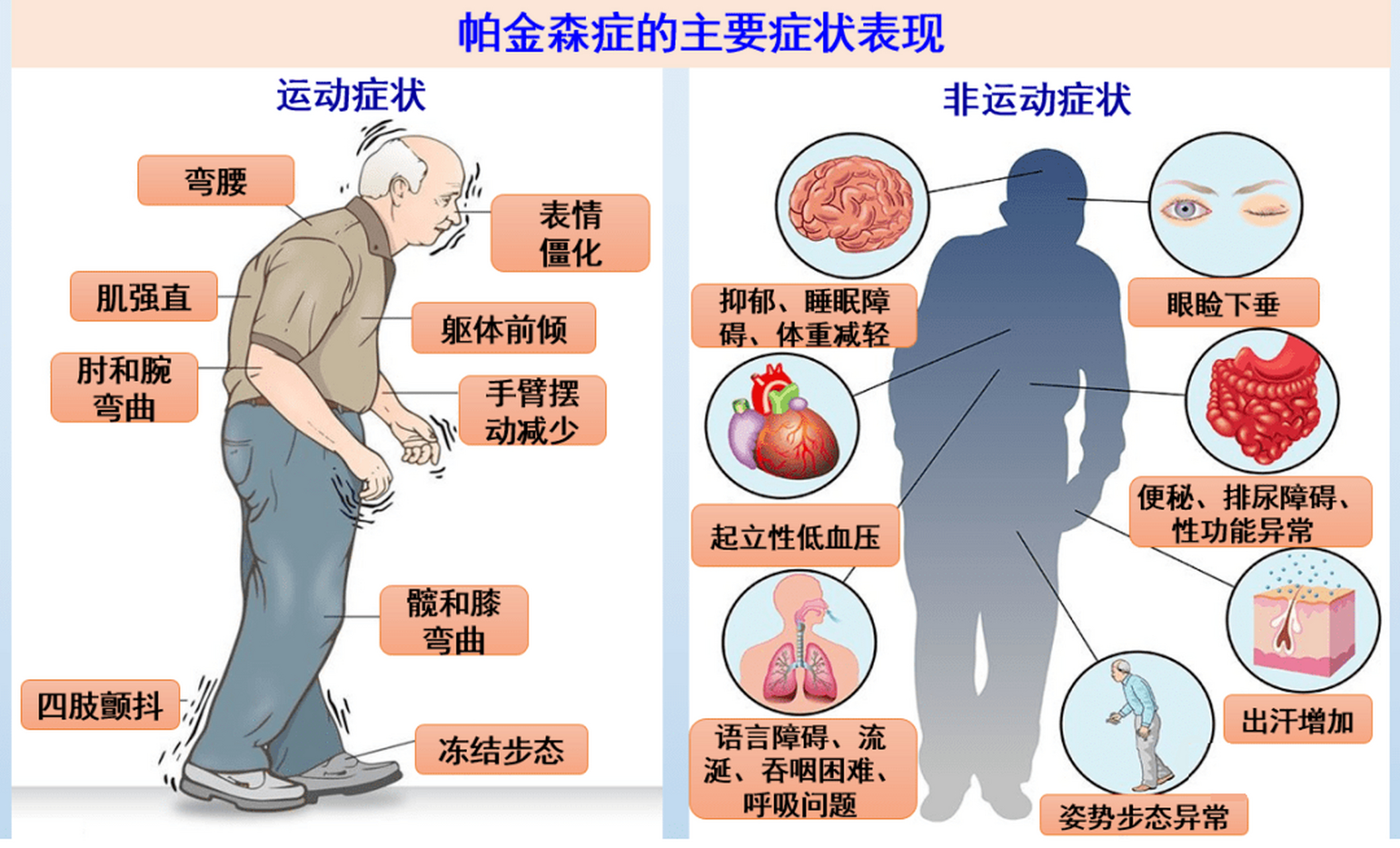 帕金森病早期与很多疾病的症状表现都很类似,容易误诊.