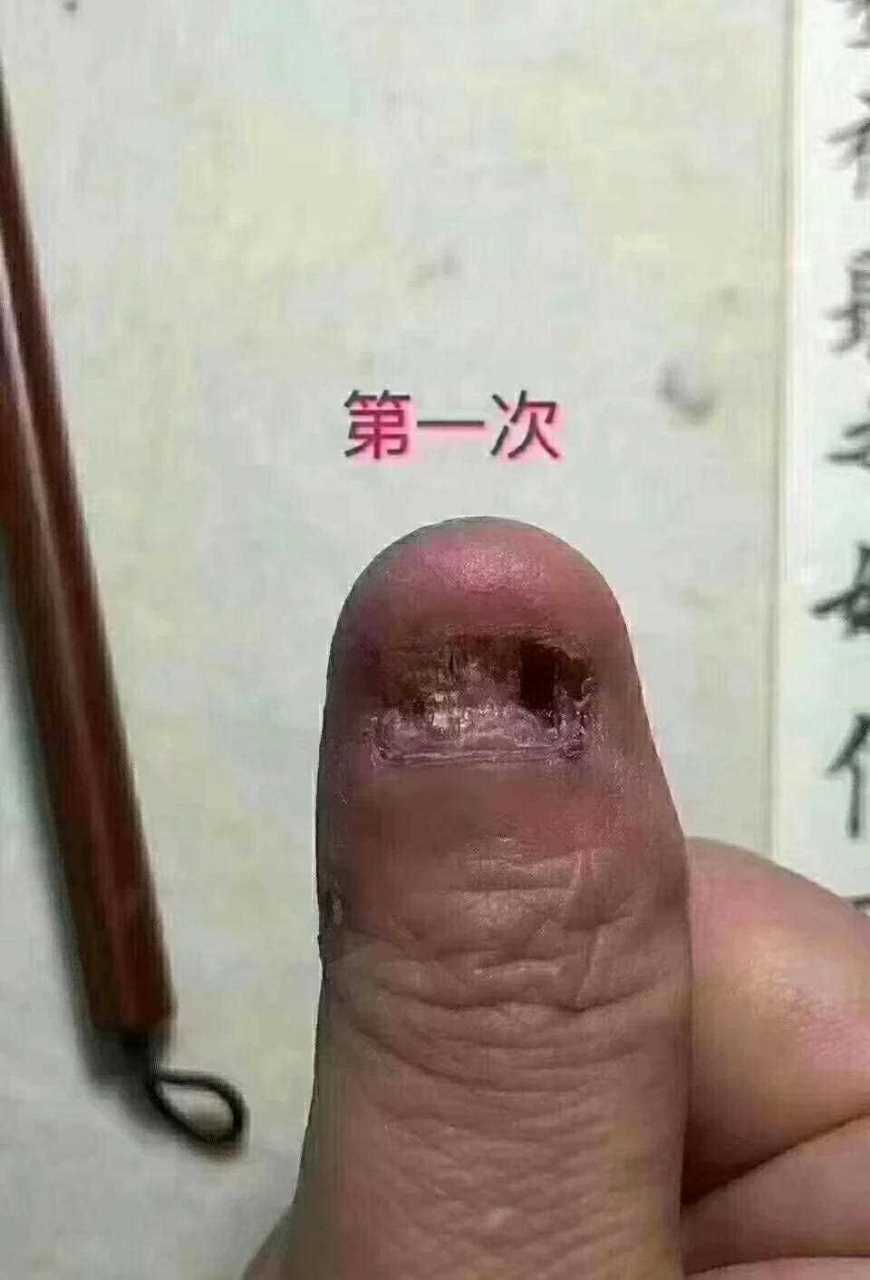 这样的效果满意吗[呲牙][害羞] 美浮特菲嘉皮肤抗菌液治灰指甲就是