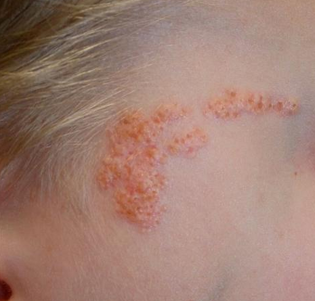 【幼儿体表肿物——皮脂腺痣,一文全知道!