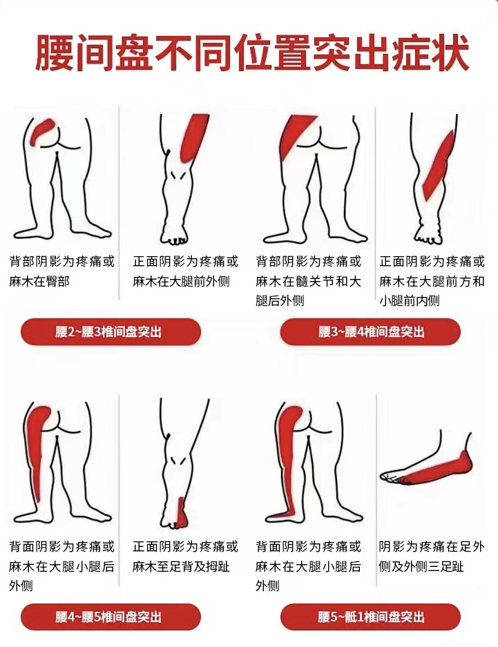 不同节段的腰突,哪些地方会腿痛,麻 1腰2/3节表现为后方臀部以及大腿