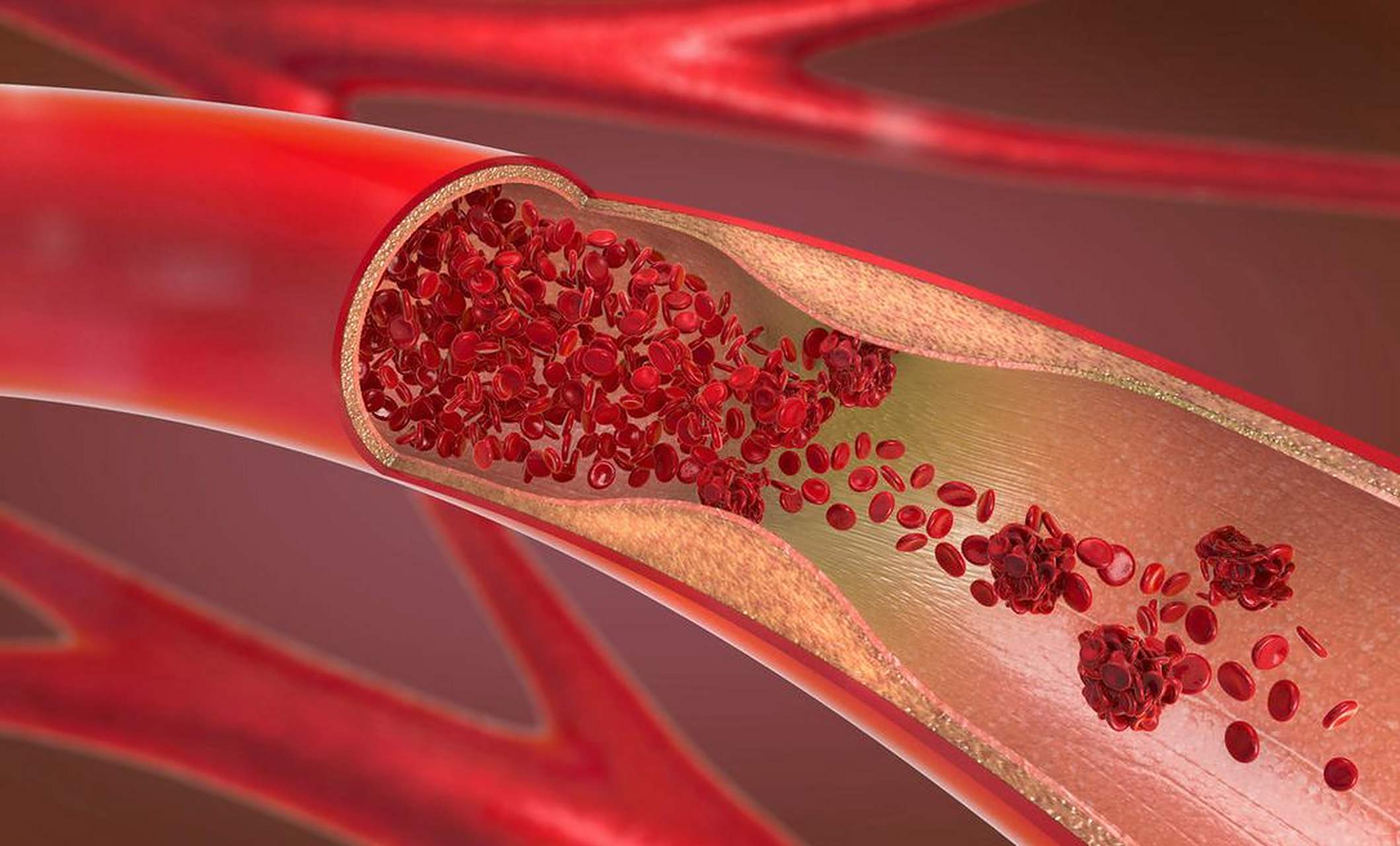 大蒜——预防动脉粥样硬化;  3.玉米——预防心血管疾病的发生; 4.