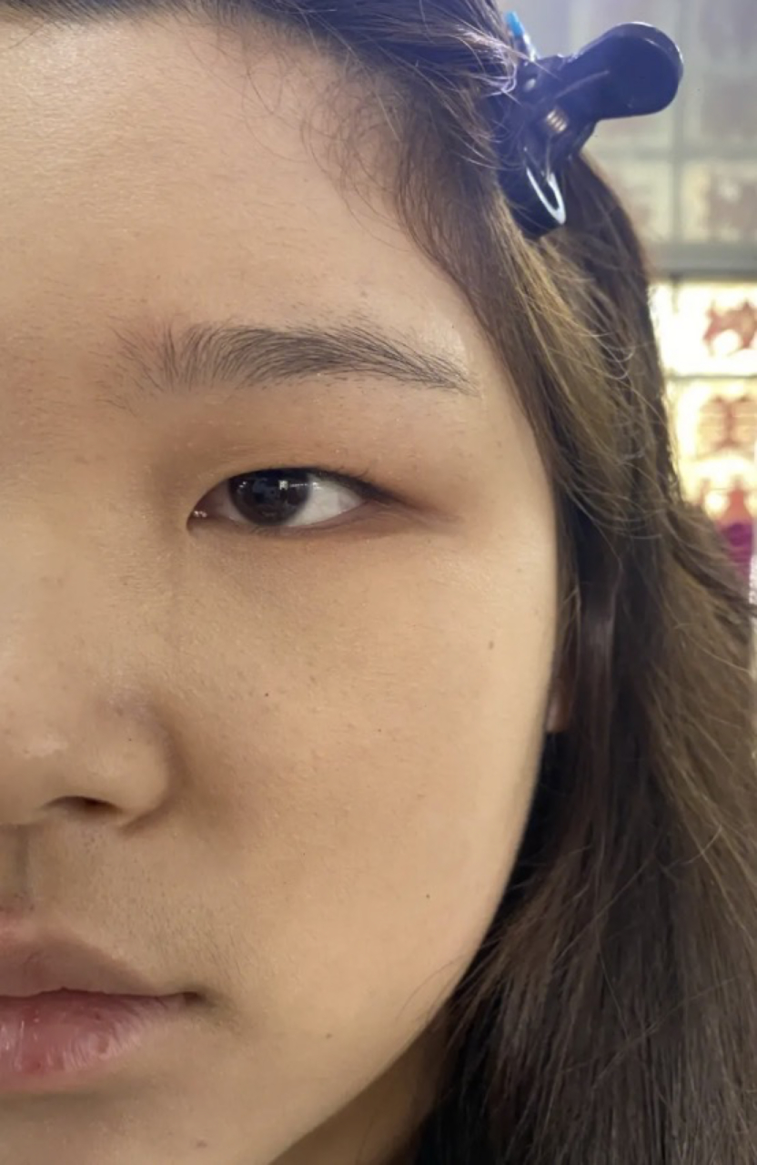 肿眼泡可以只抽脂不割双眼皮吗?