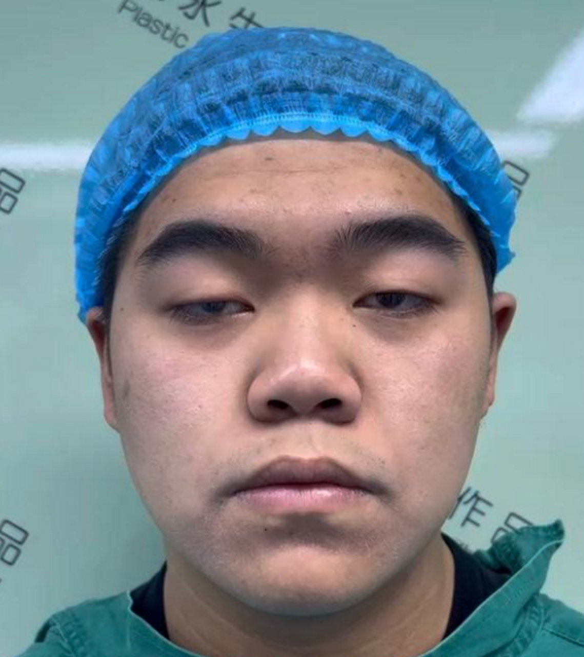 大家要记住哦,上睑下垂矫正不等同于双眼皮手术哦 虽然都是通过上眼睑