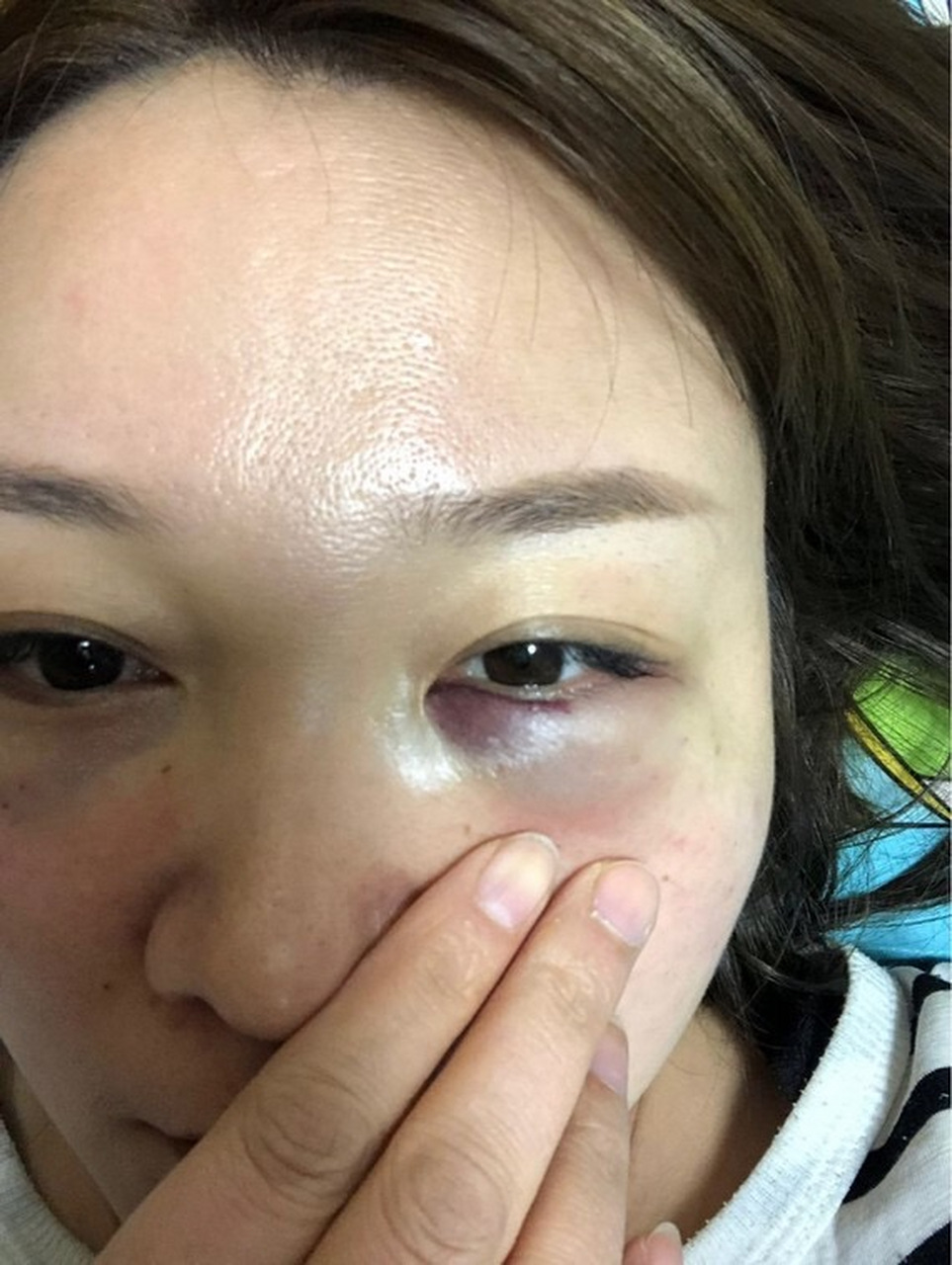 旨在改善下眼睑区域的凹陷和泪沟