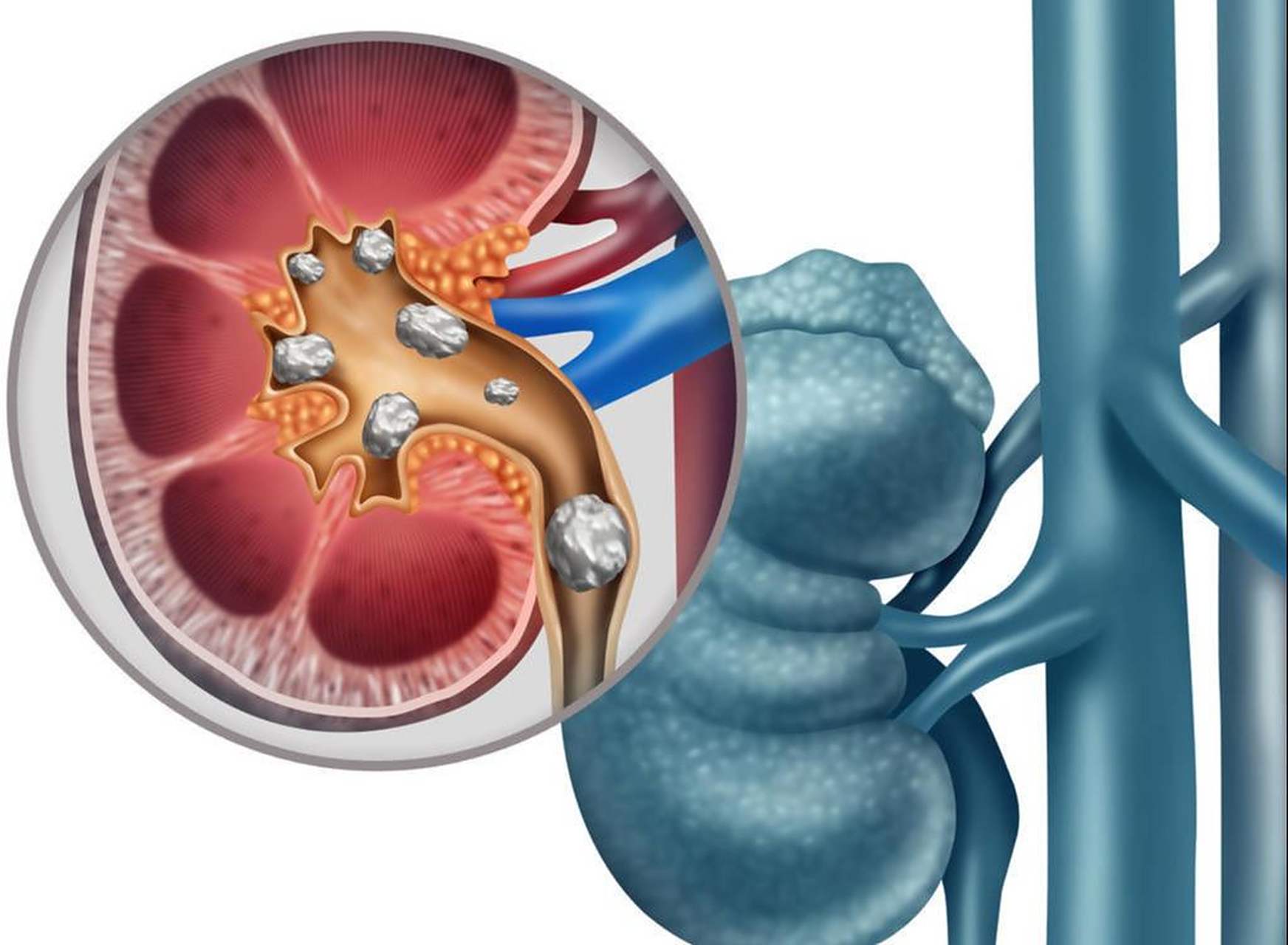 肾结石是泌尿外科的常见病之一,我国泌尿系结石发病率为1%～5%,慕方