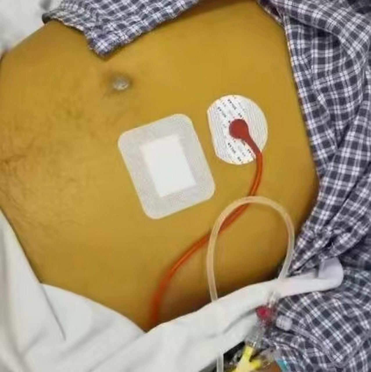 肝硬化患者,在当地医院治疗效果不佳,黄疸一直下不去,到院一检查门