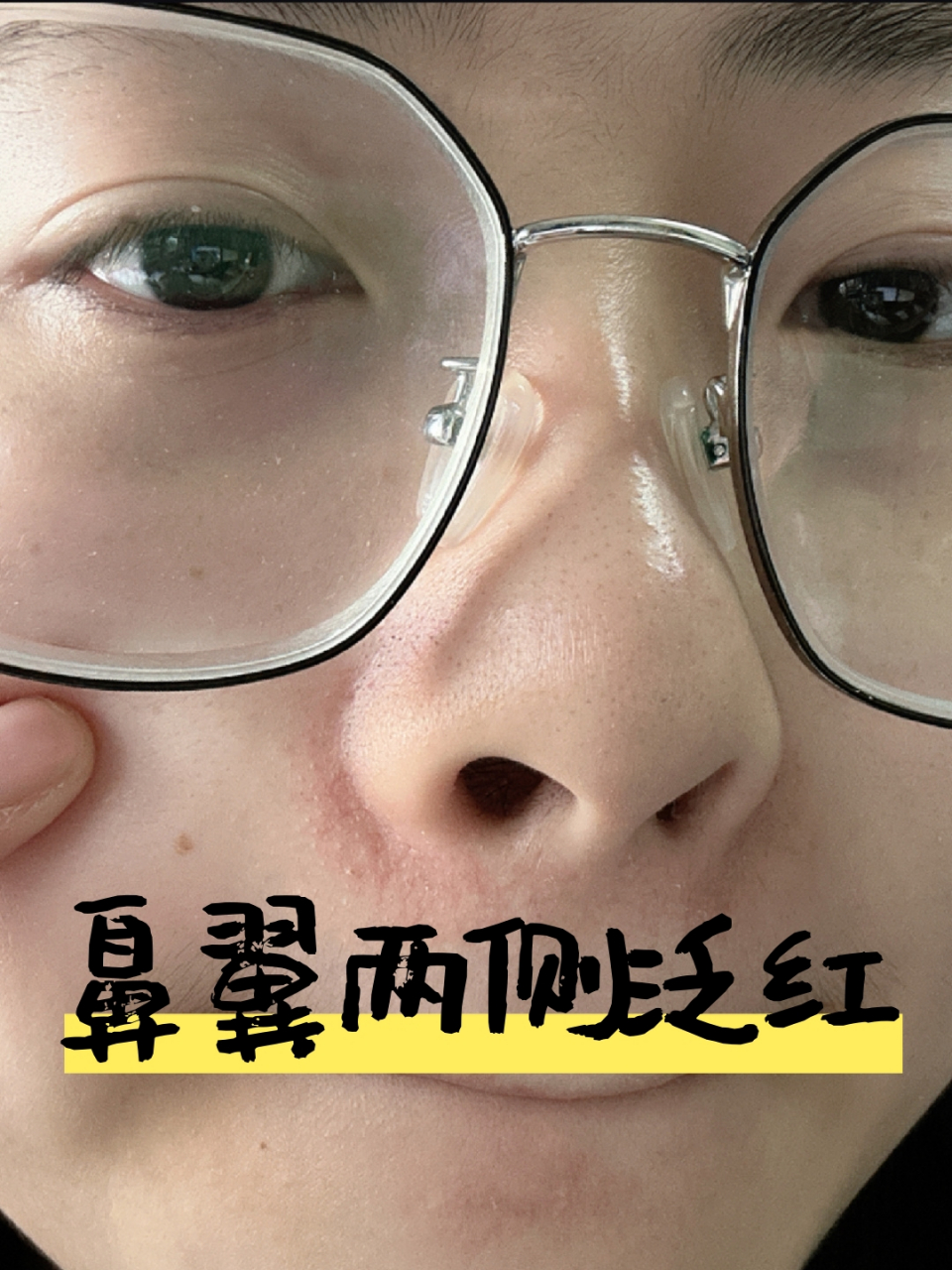 最近鼻翼两侧泛红,请问各位刘亦菲,这种情况应该怎么