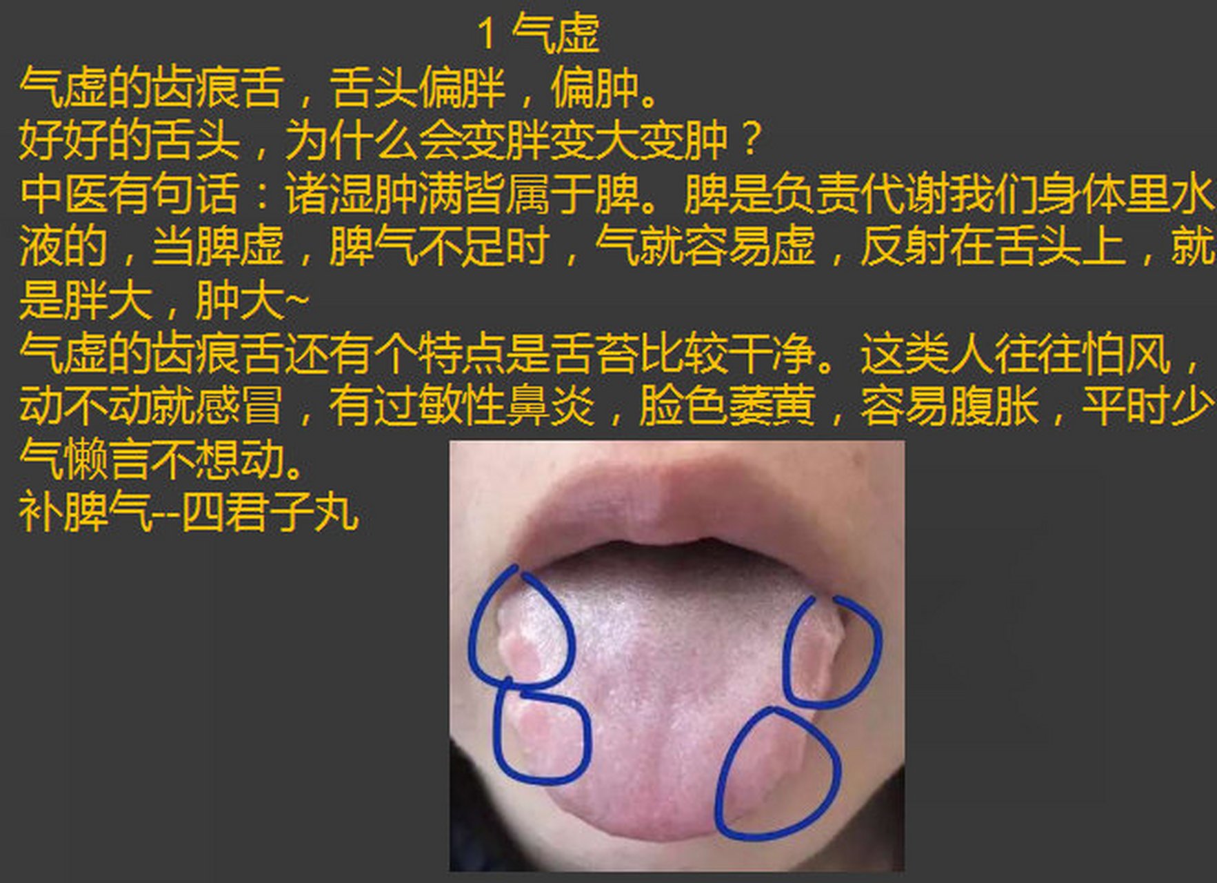 气血虚,阳虚,湿热,都会有齿痕舌.看看他们都是怎么形成的吧.