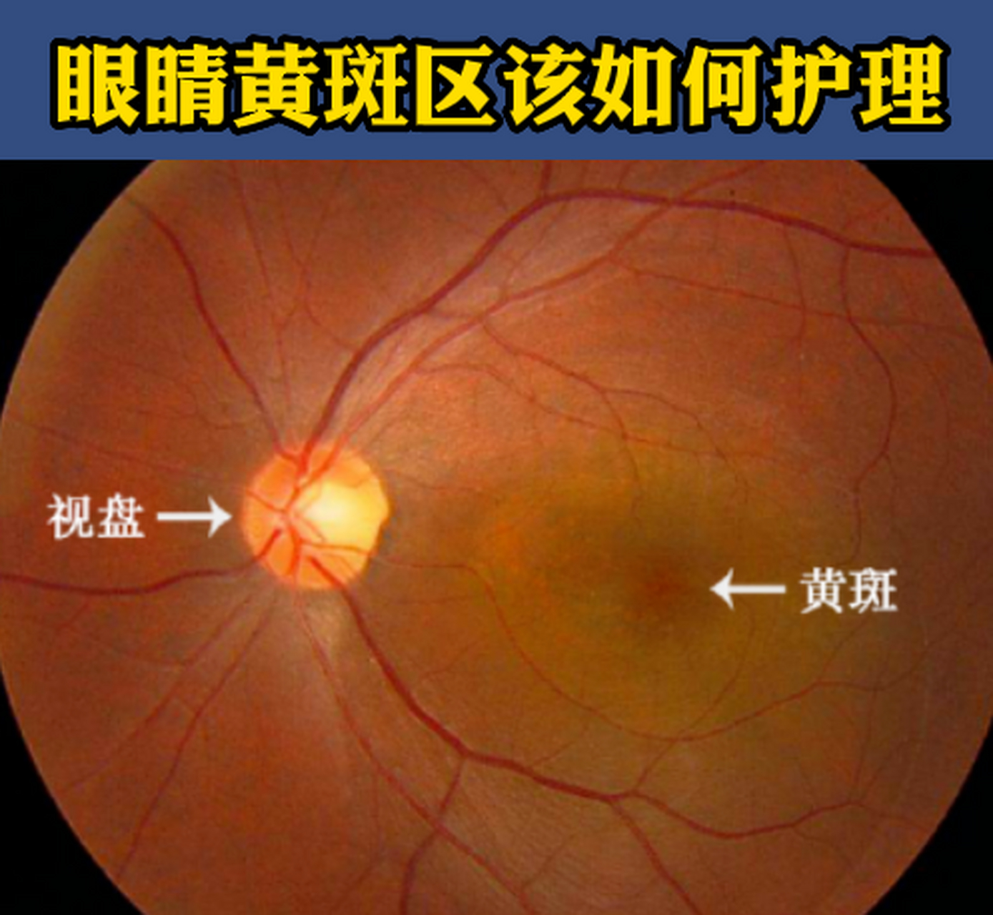 眼睛有黄斑怎么治疗图片