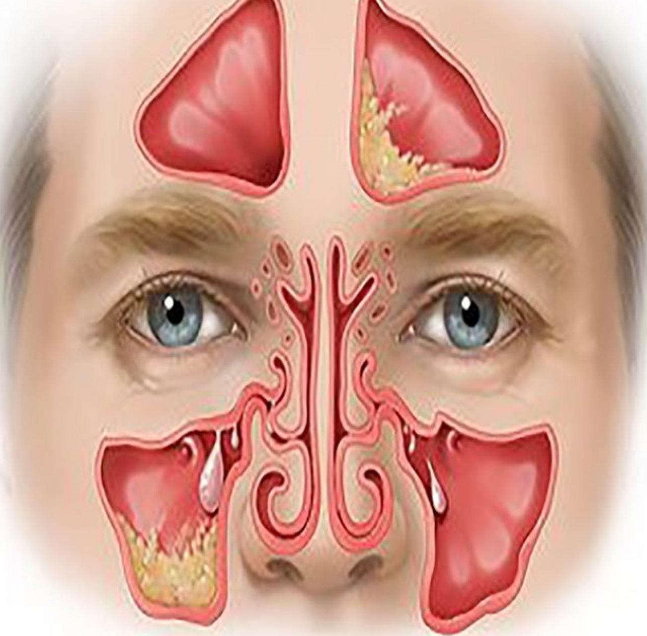 由于鼻窦发生炎症感染的最主要窦腔不同,导致的疼痛位置也不相同.
