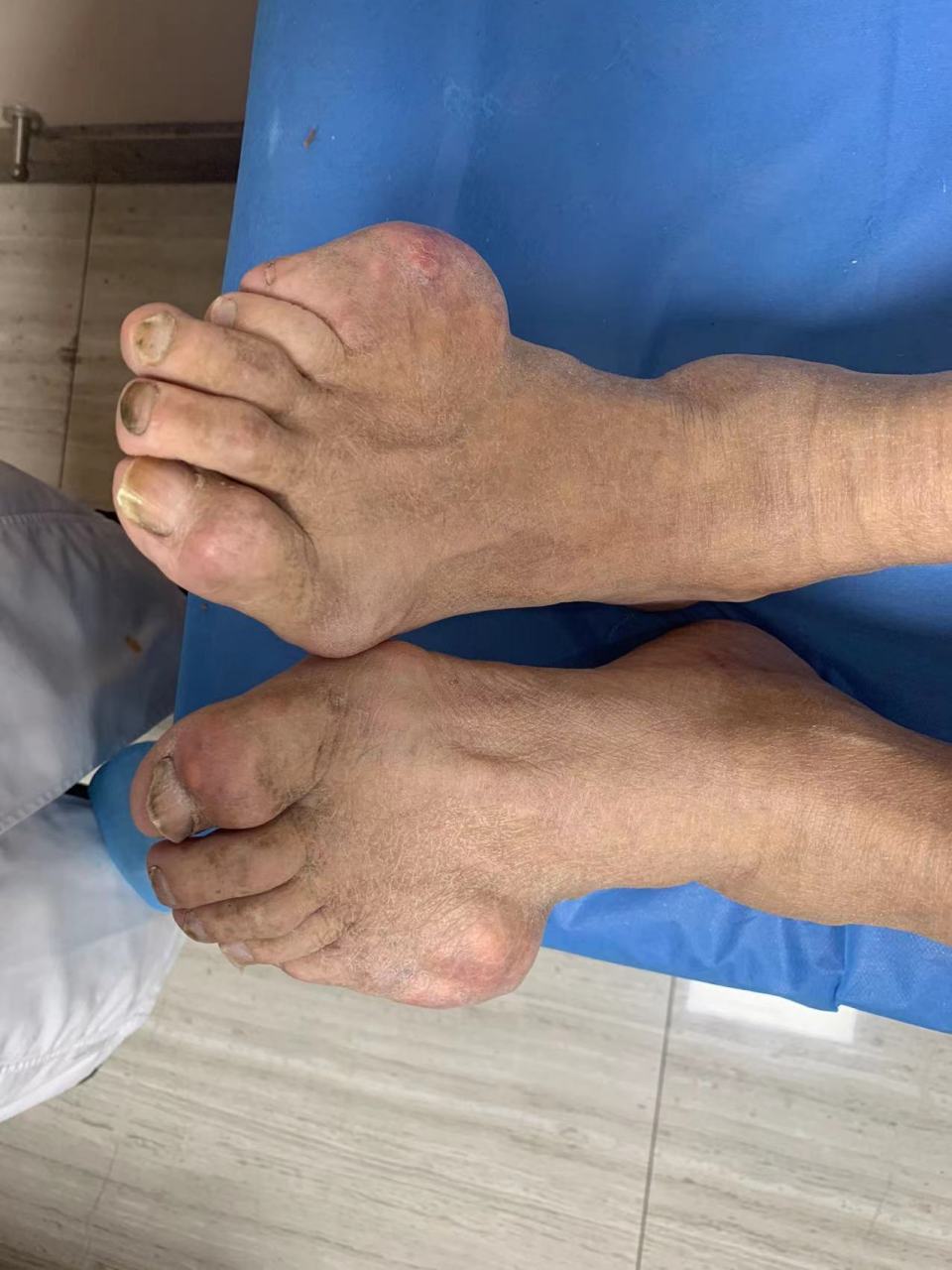 如果你的痛风只是尿酸高,偶尔关节红肿热痛,长了小的痛风石,但肾功能