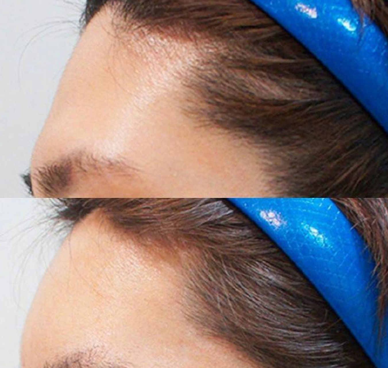 我一直不建议用玻尿酸来填充额头 因为玻尿酸填充它很有可能出现位移