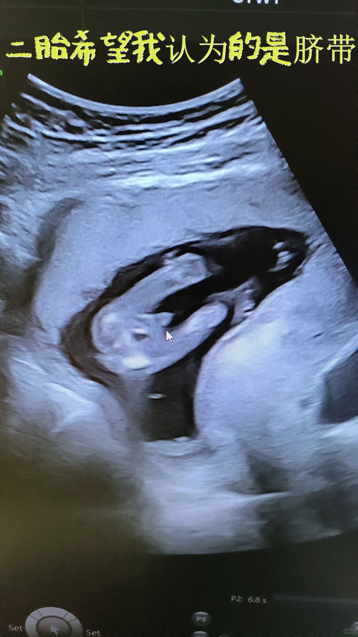 二胎希望我认为的是脐带 16周专门去看的,一胎知道是个儿子略失望,想