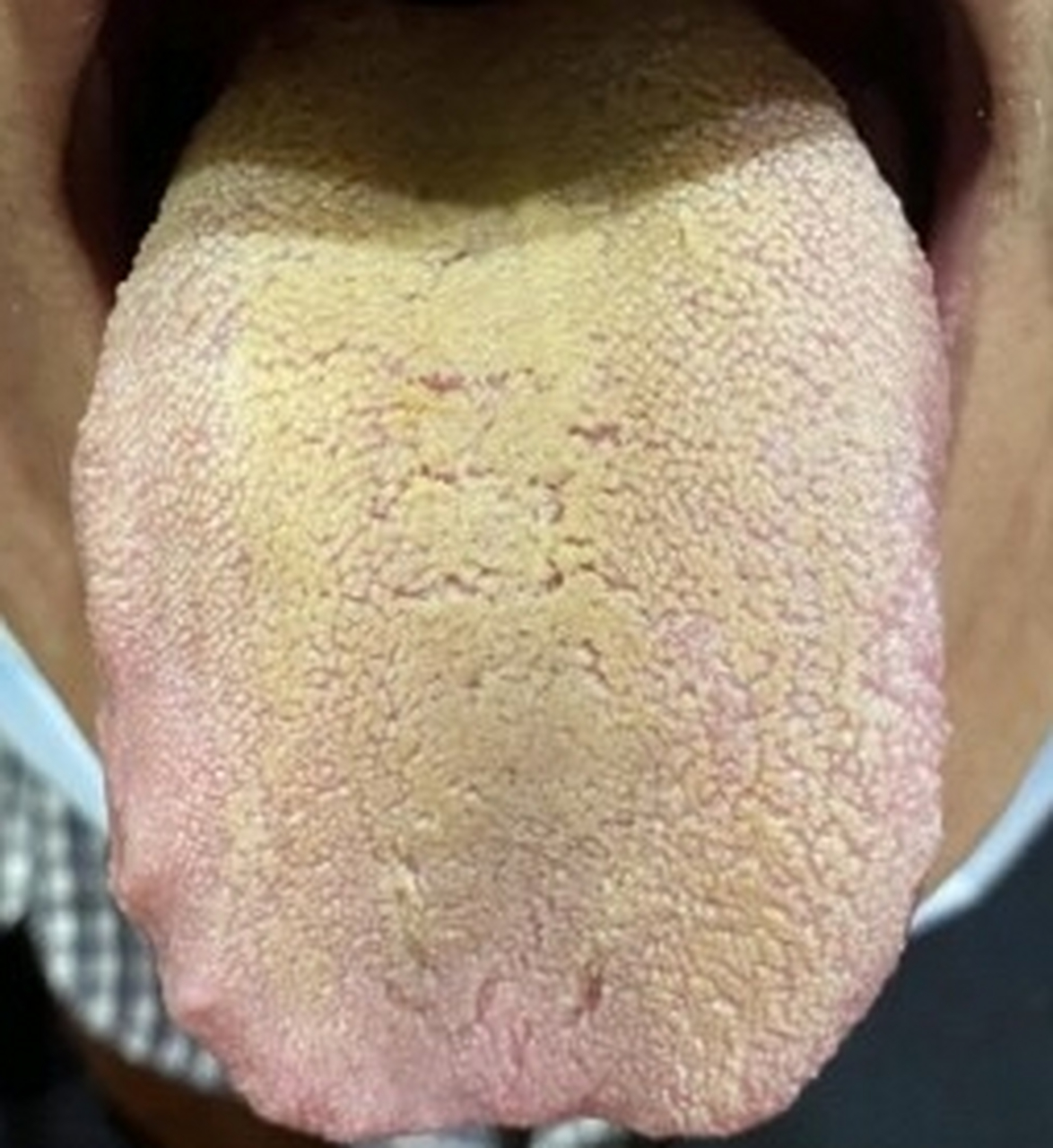 肠胃湿热舌头图片图片