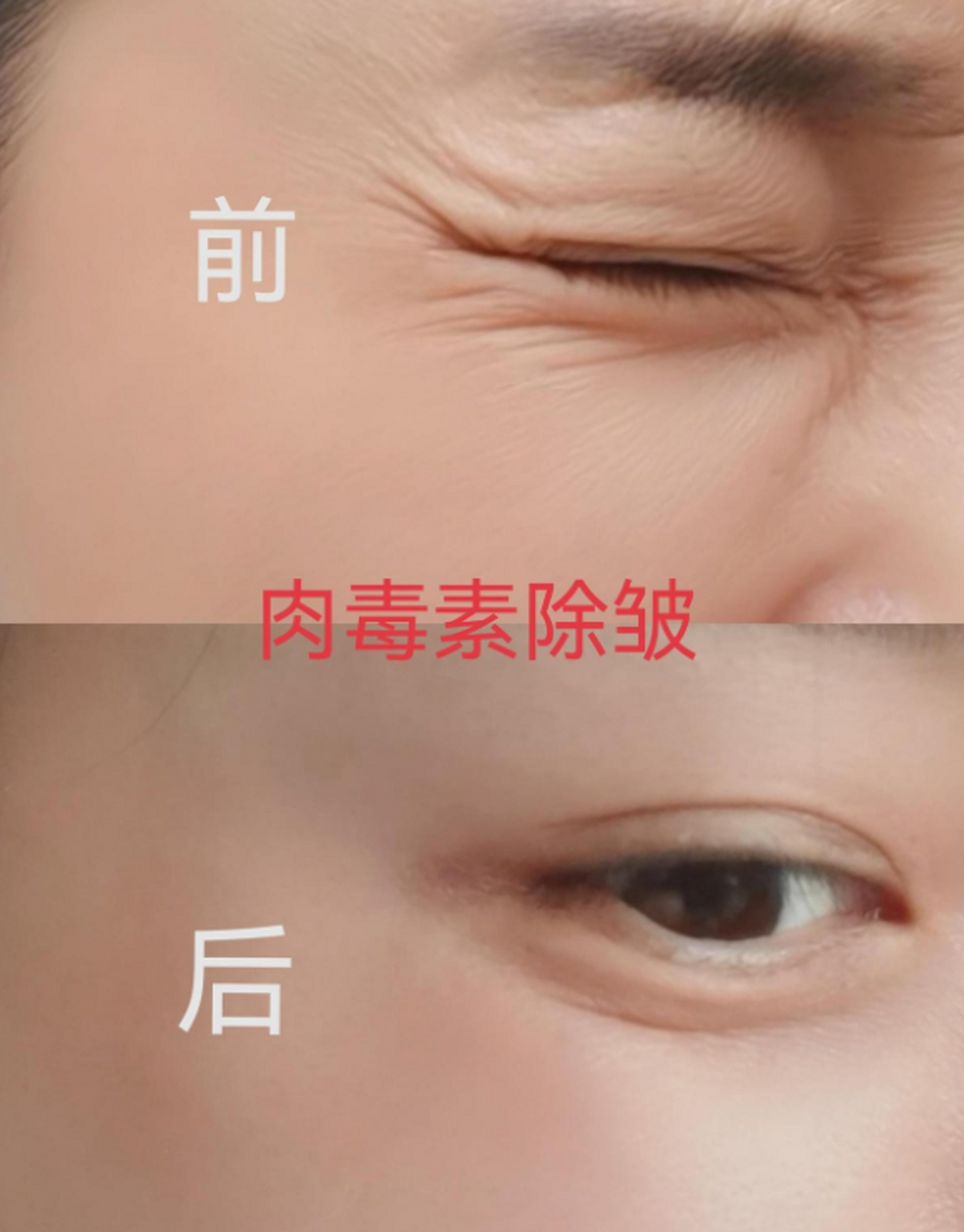 鱼尾纹打肉毒素是可能会出现副作用的,主要是表情僵硬不自然,两侧