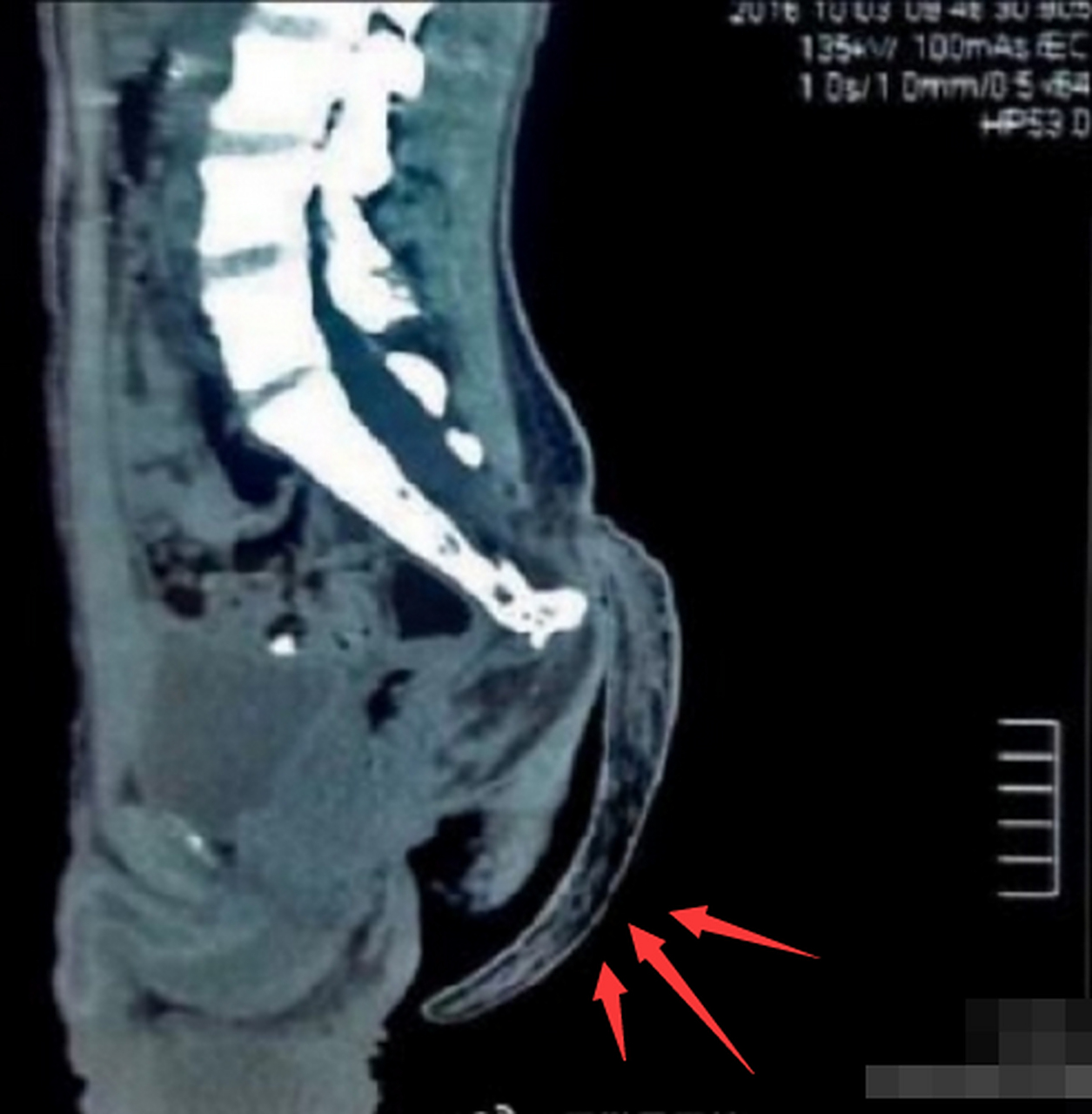 这个17岁男孩从出生时就长了一条尾巴,由于迷信等原因