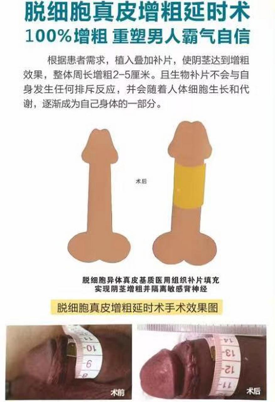 脱细胞真皮增粗延时术100%增粗重塑男人霸气自信