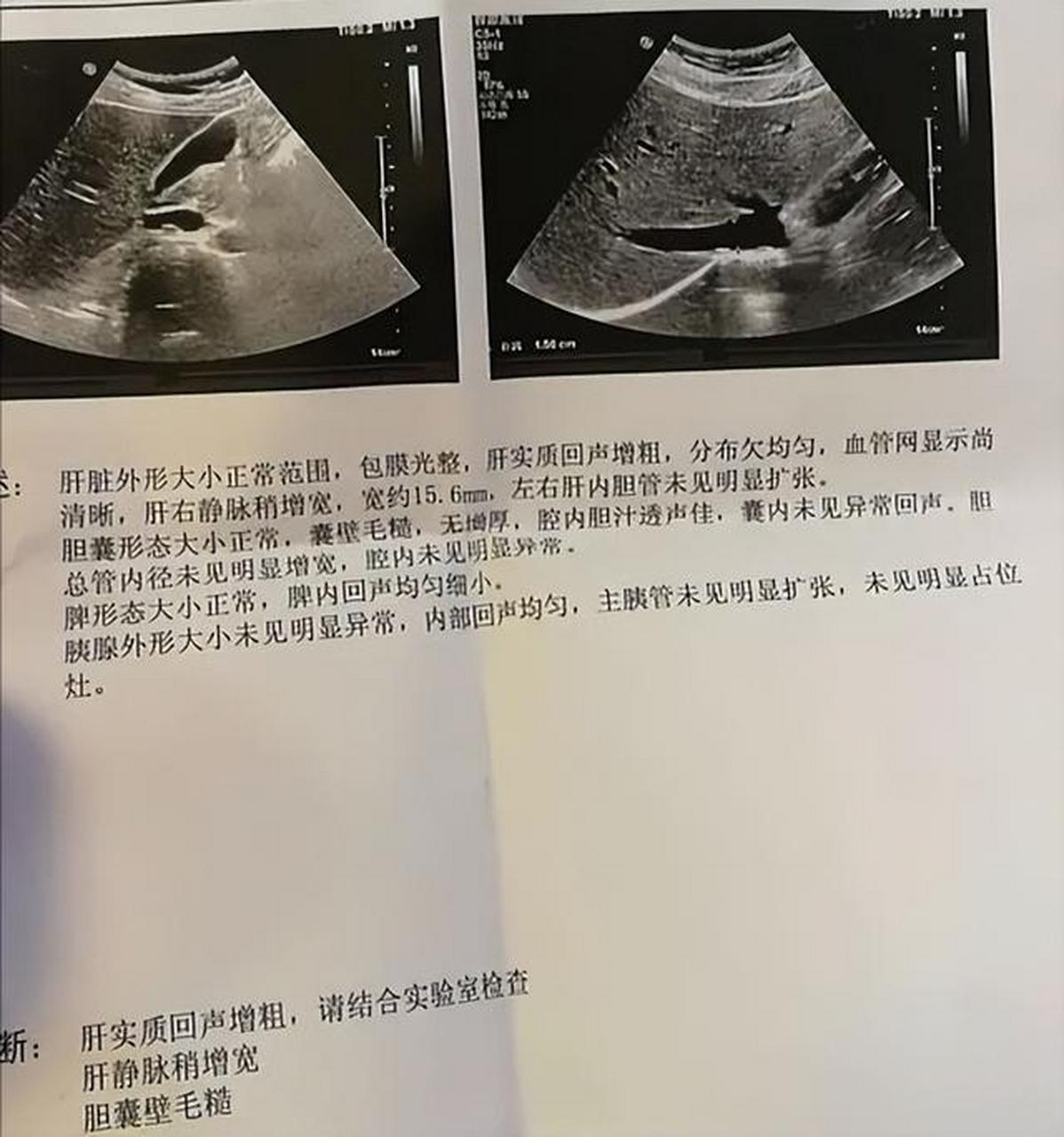 脂肪肝,酒精肝 肝回声增粗说明肝脏有了损伤,脂肪浸润等问题,常见的