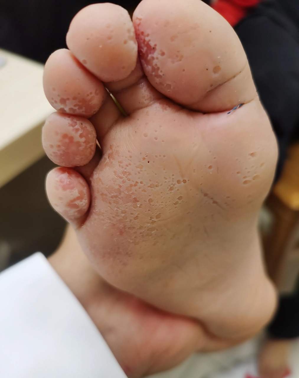 小朋友踢足球,晚上洗脚发现脚底全是这种小坑坑,以为就是脚气,涂