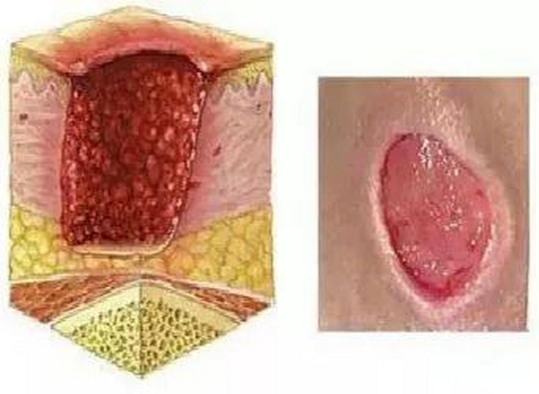肉芽组织(granulation tissue):由新生薄壁的毛细血管以及增生的纤维
