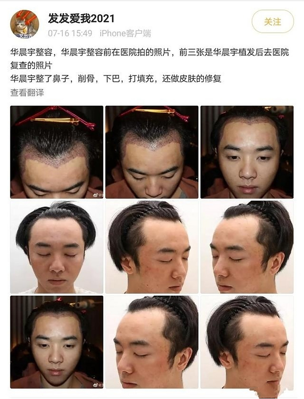 华晨宇整容照曝光?公司回应只是治疗皮肤!