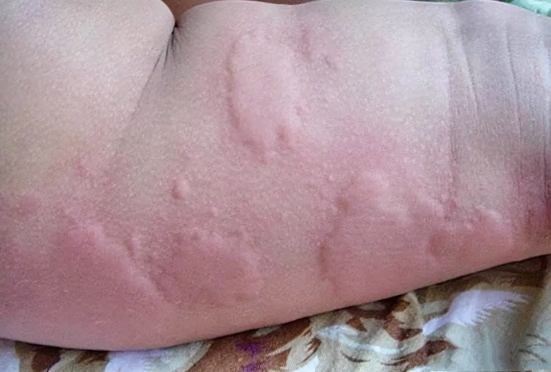 儿童荨麻疹是一种常见的儿童皮肤病,它的发病率高达20%左右.