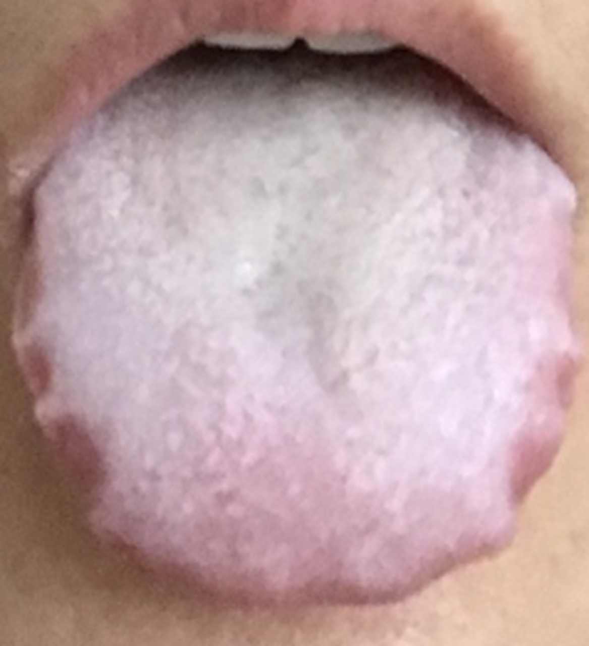 我们来看这个粉丝的舌象,先看舌苔的颜色,是白色的,说明没有化热.
