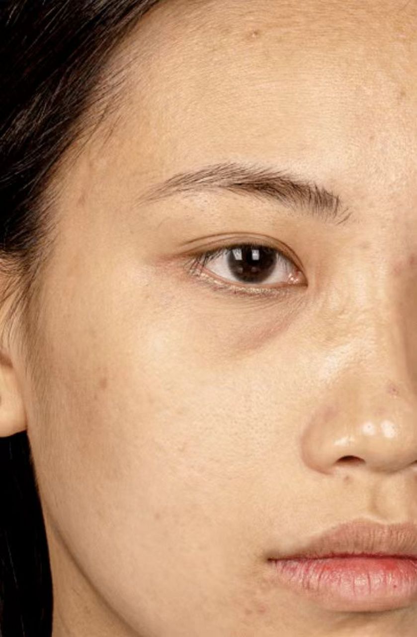 注射去面部细纹# 脸上有细纹 怎么去掉 宝宝们,如果你们已经开始诚种