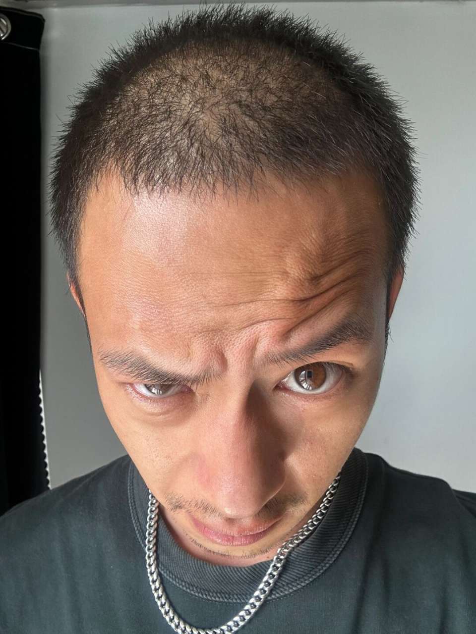 最近见着人都说我越来越秃了 上次剪头发也肉眼可见的开始m秃 我南耨