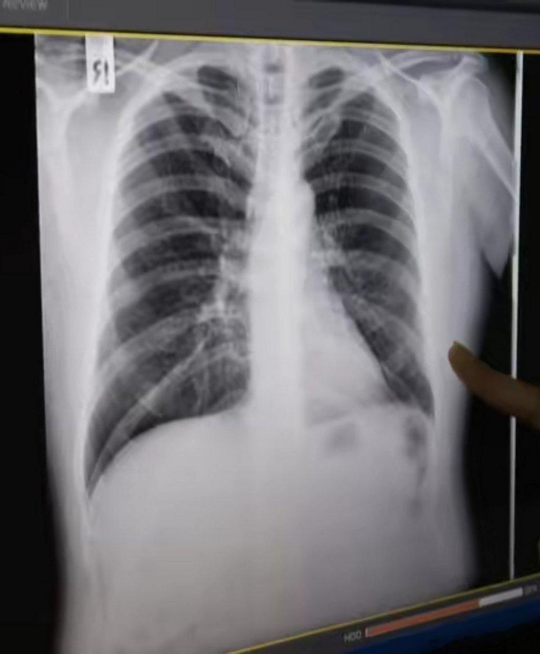 1,肺大泡 即肺大疱,属于局限性肺气肿,一般只需注意避免剧烈咳嗽远