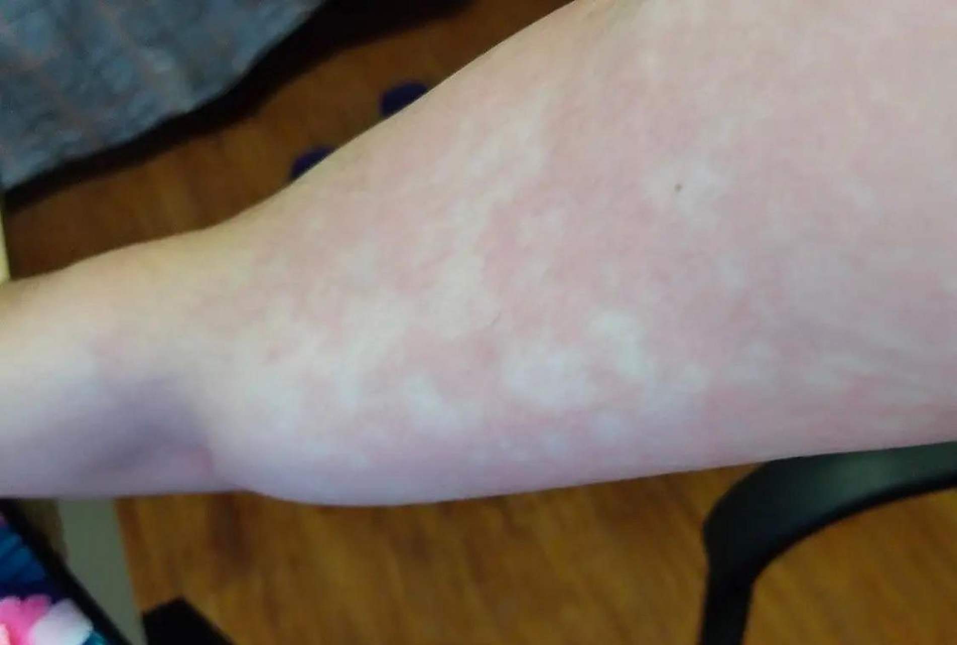 这是酒精过敏吗? #中国版chatgpt来了# #趣图搞笑