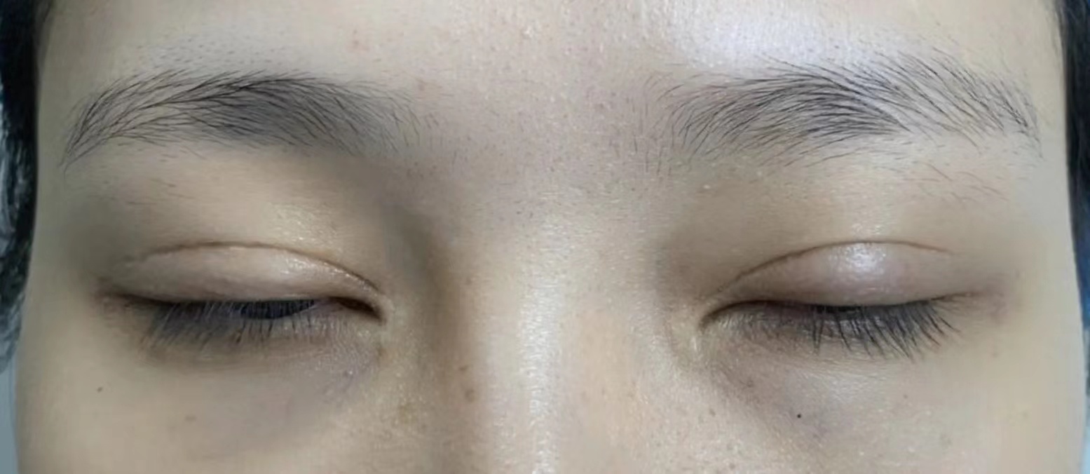 为什么双眼皮术后闭眼疤痕比较明显?