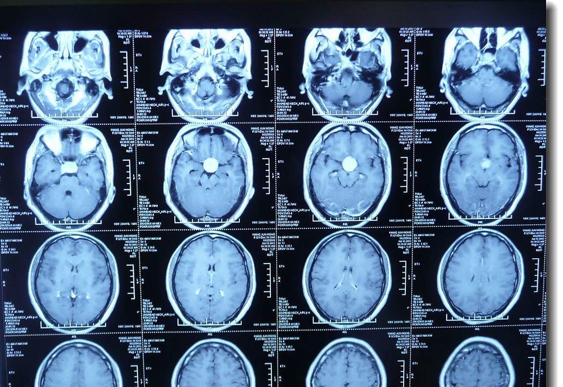 【垂体瘤开颅手术切除案例】 患者女,32岁