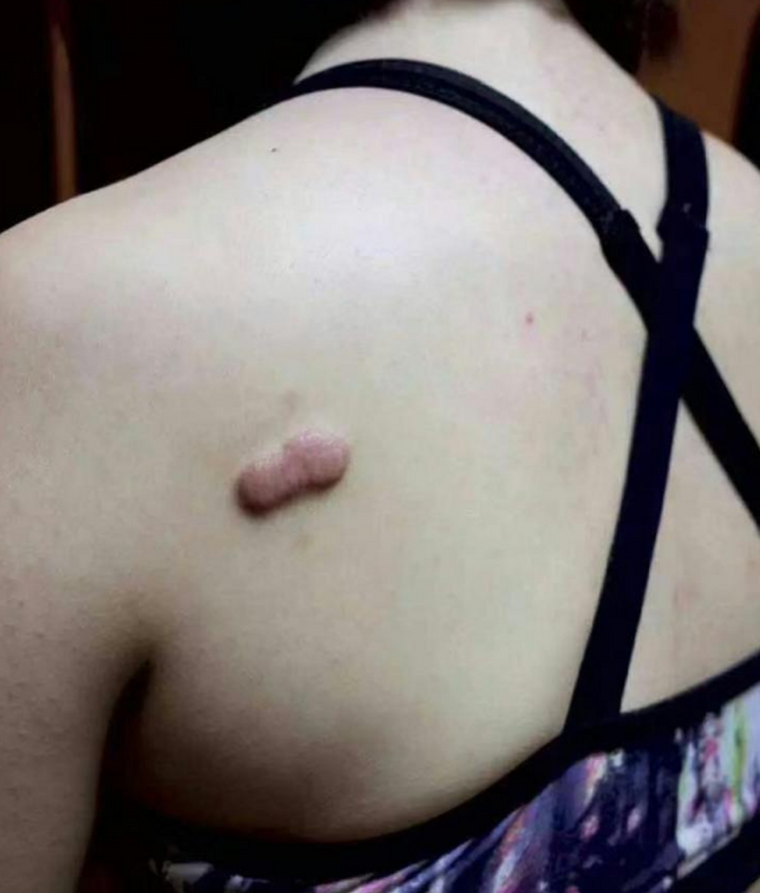 这个纹身遮疤很成功诶!有立体的效果诶!