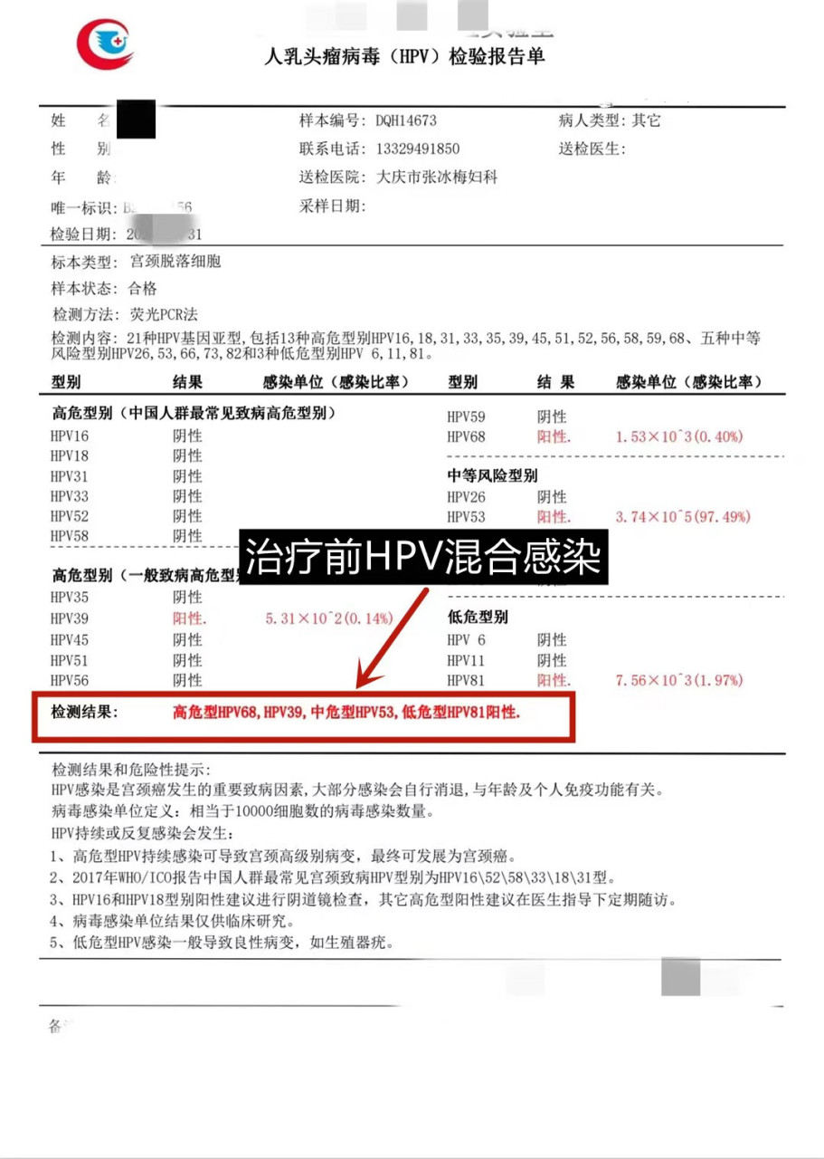 吉林的张女士宫颈部位感染,hpv68,39,53,81四个hpv病毒,经朋友介绍