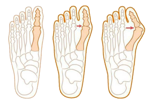 什么是拇外翻?
