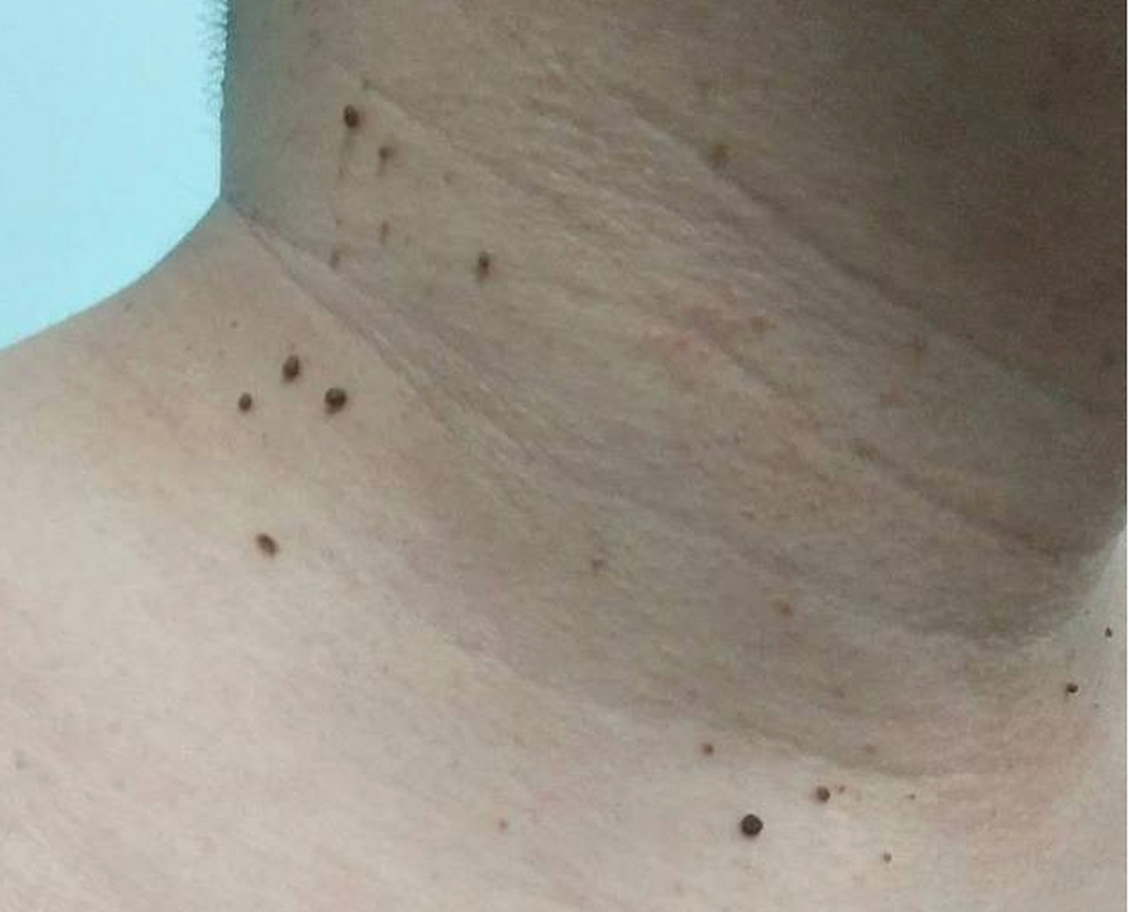 丝状疣是由hpv感染引起的一种皮肤疾病,常见于脸部,眼睑周围,嘴唇