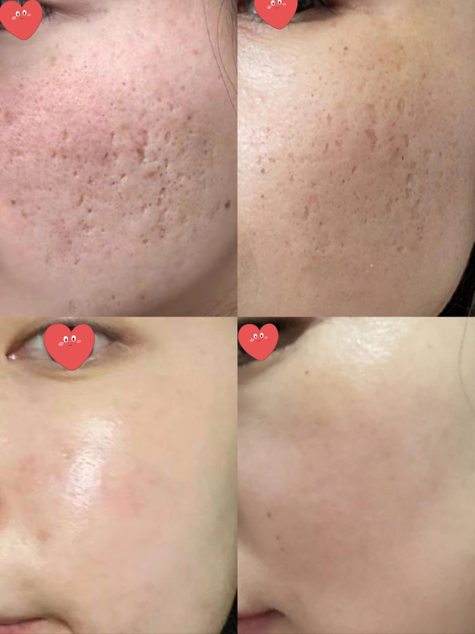 祛痘坑,祛痘印并不是简单的事 不管是男孩子还是女孩子 谁愿意自己