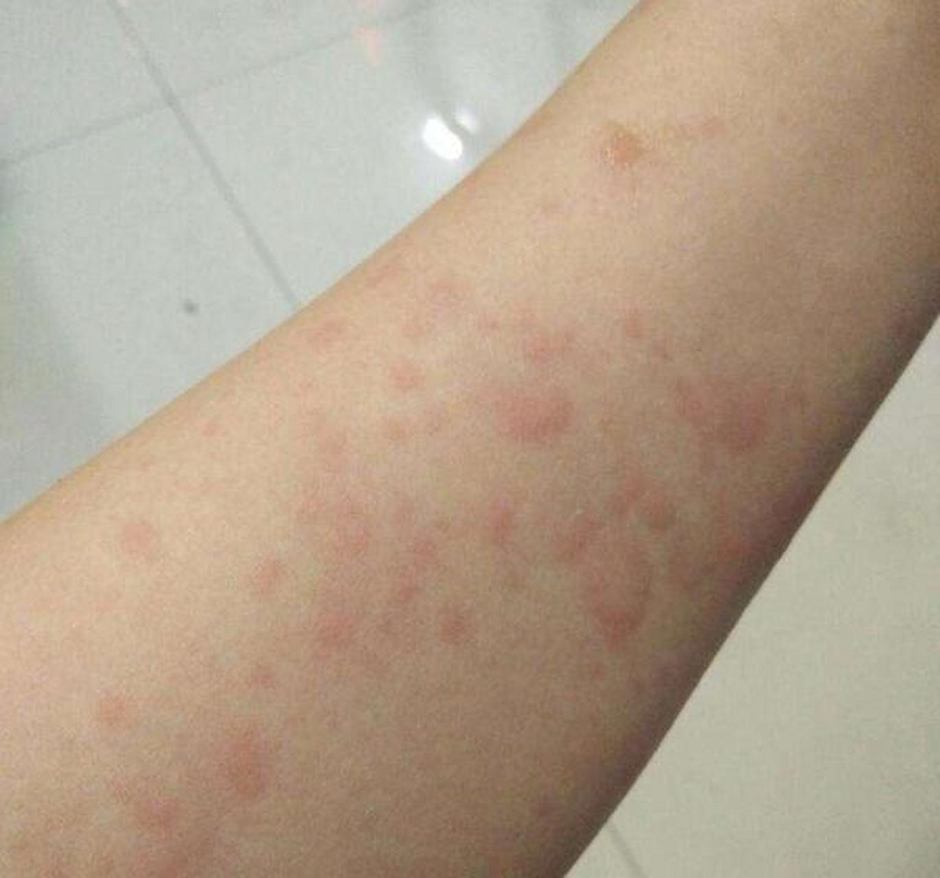 轻松干掉荨麻疹十多年没发作,原来是用了这个方法,今天告诉大家一个