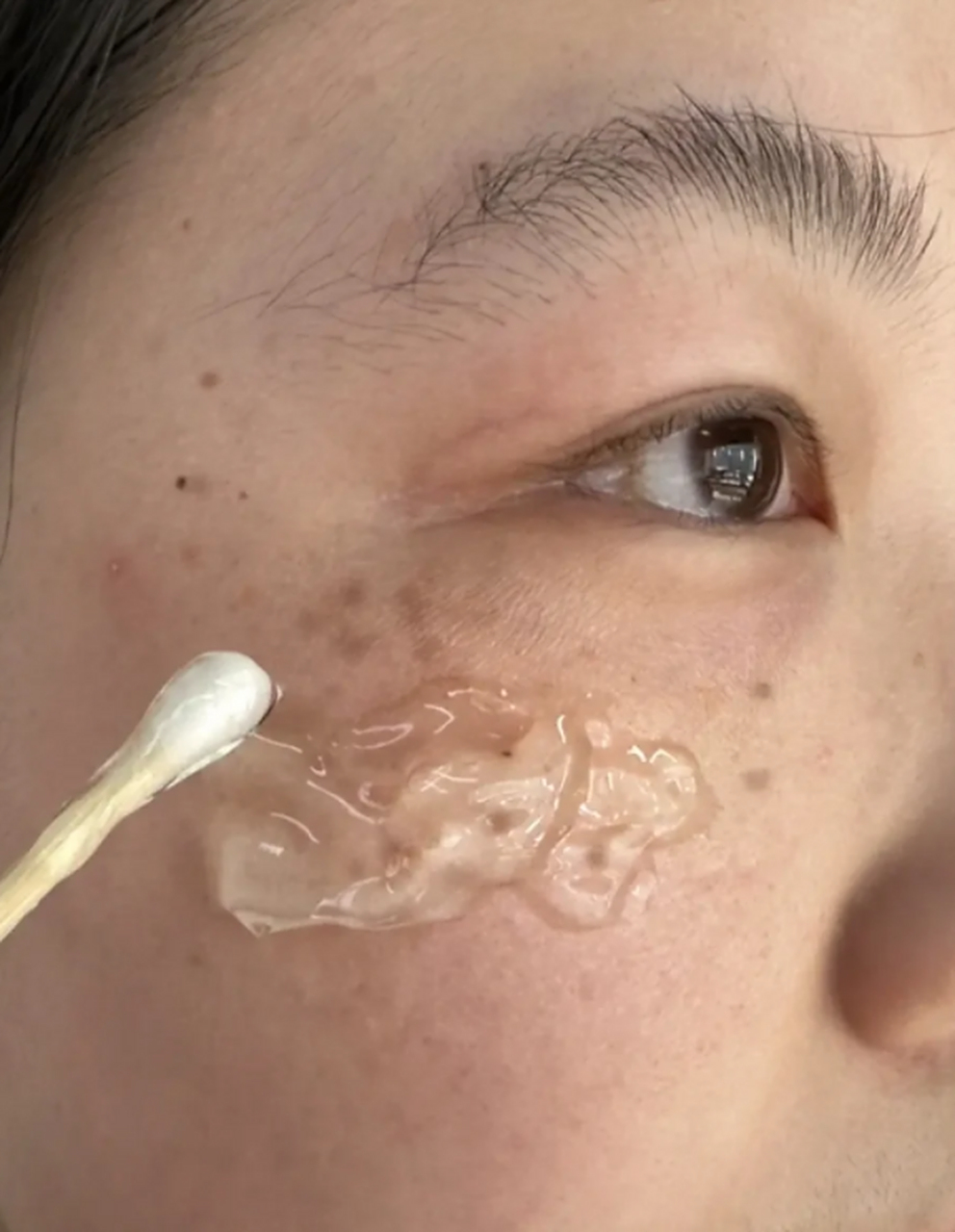 通过利用高能量激光照射皮肤,去除色素沉着,达到淡化斑点的效果