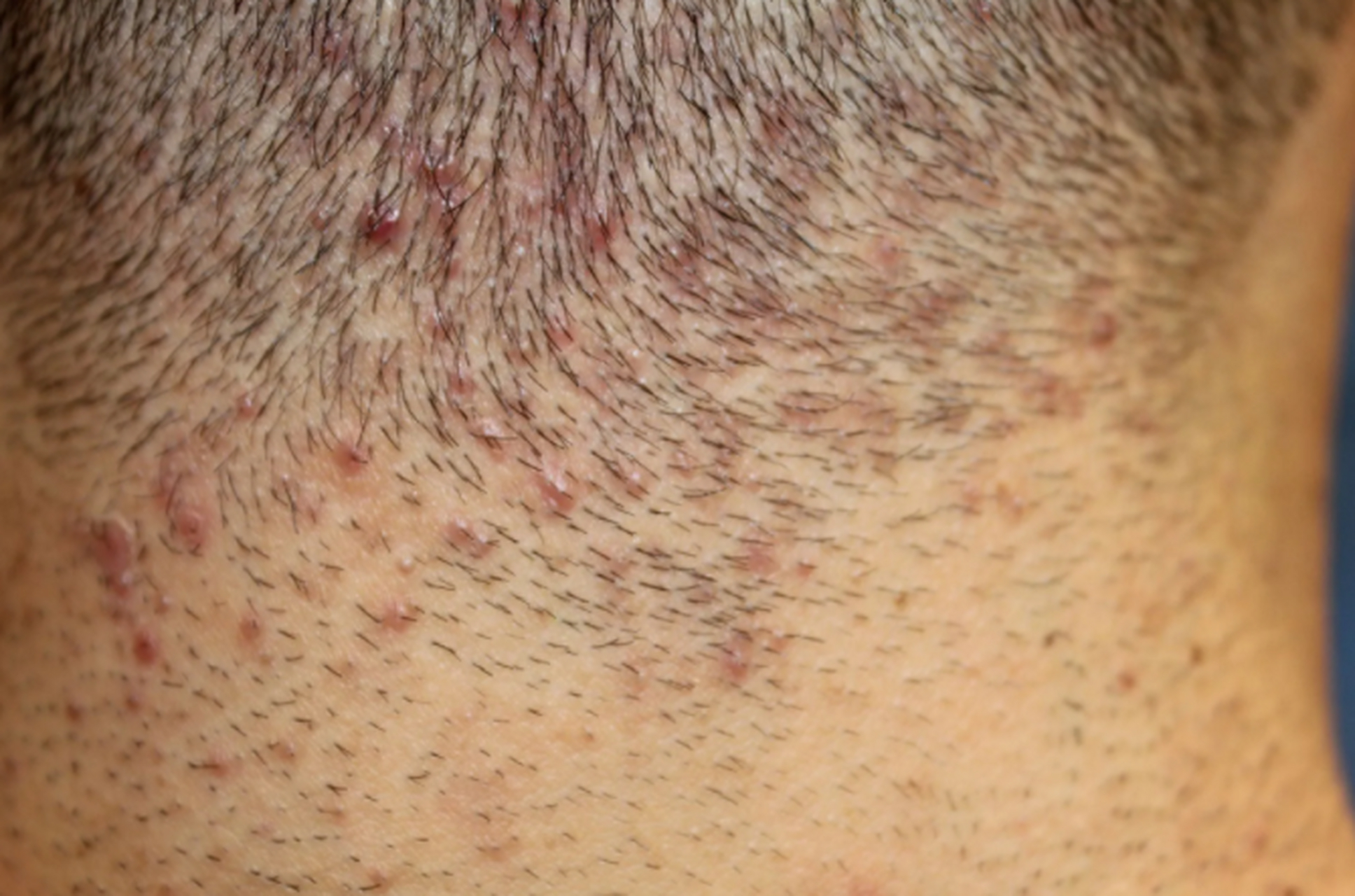 夏季,天气炎热,也是毛囊炎的高发季节,头皮上除了反复长红痘,白外外