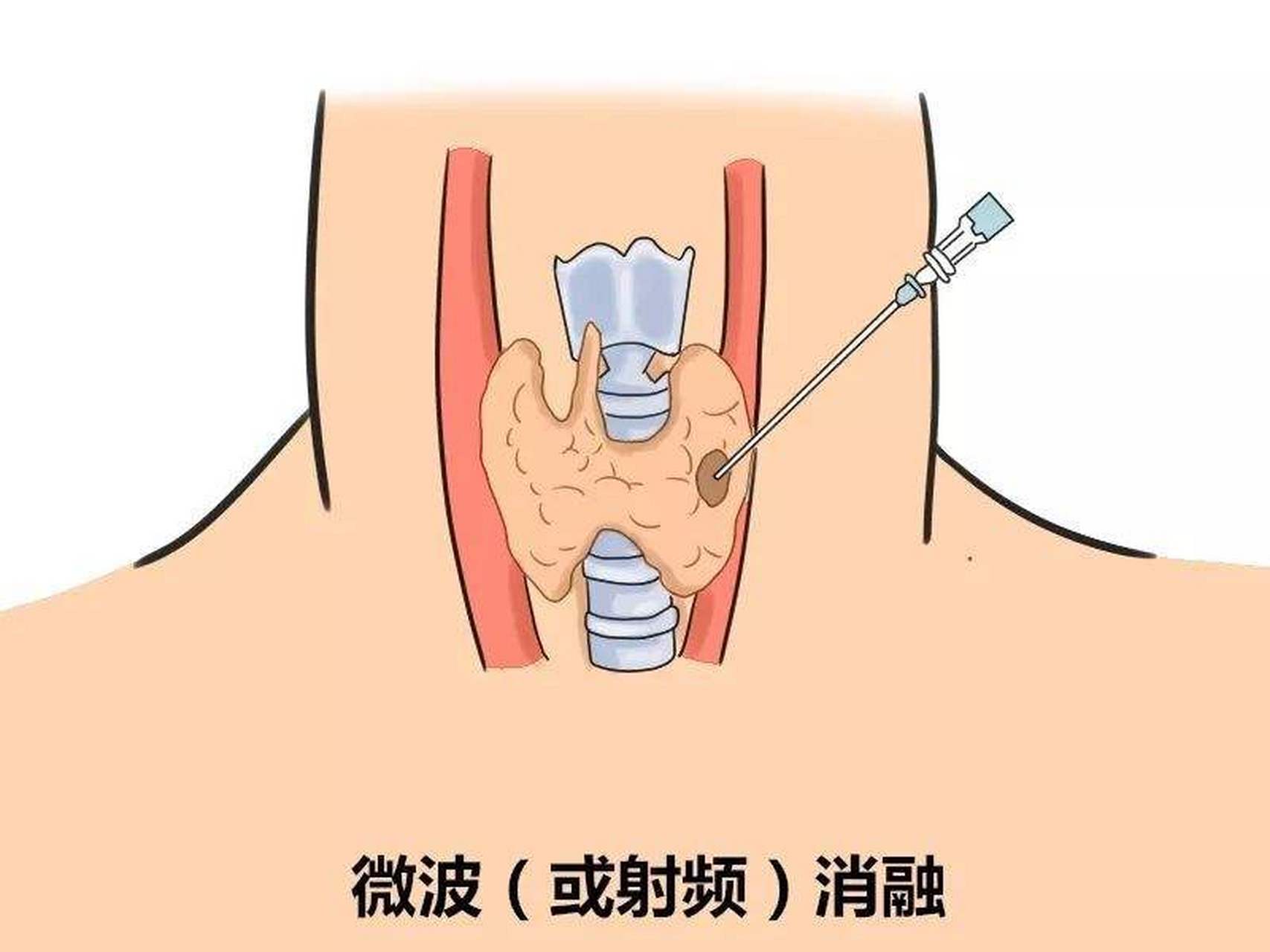 【大白话讲:消融术治疗甲状腺结节的原理 通俗的说消融就是把一根带