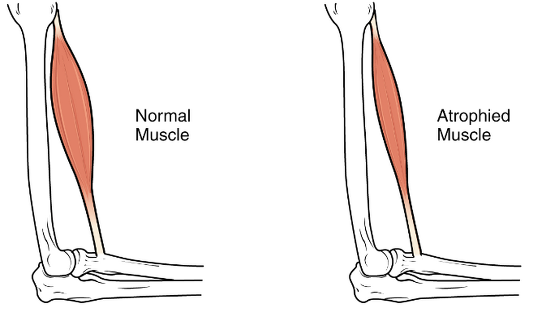 杜氏肌营养不良 (duchenne muscular dystrophy,dmd) 是一种罕见的