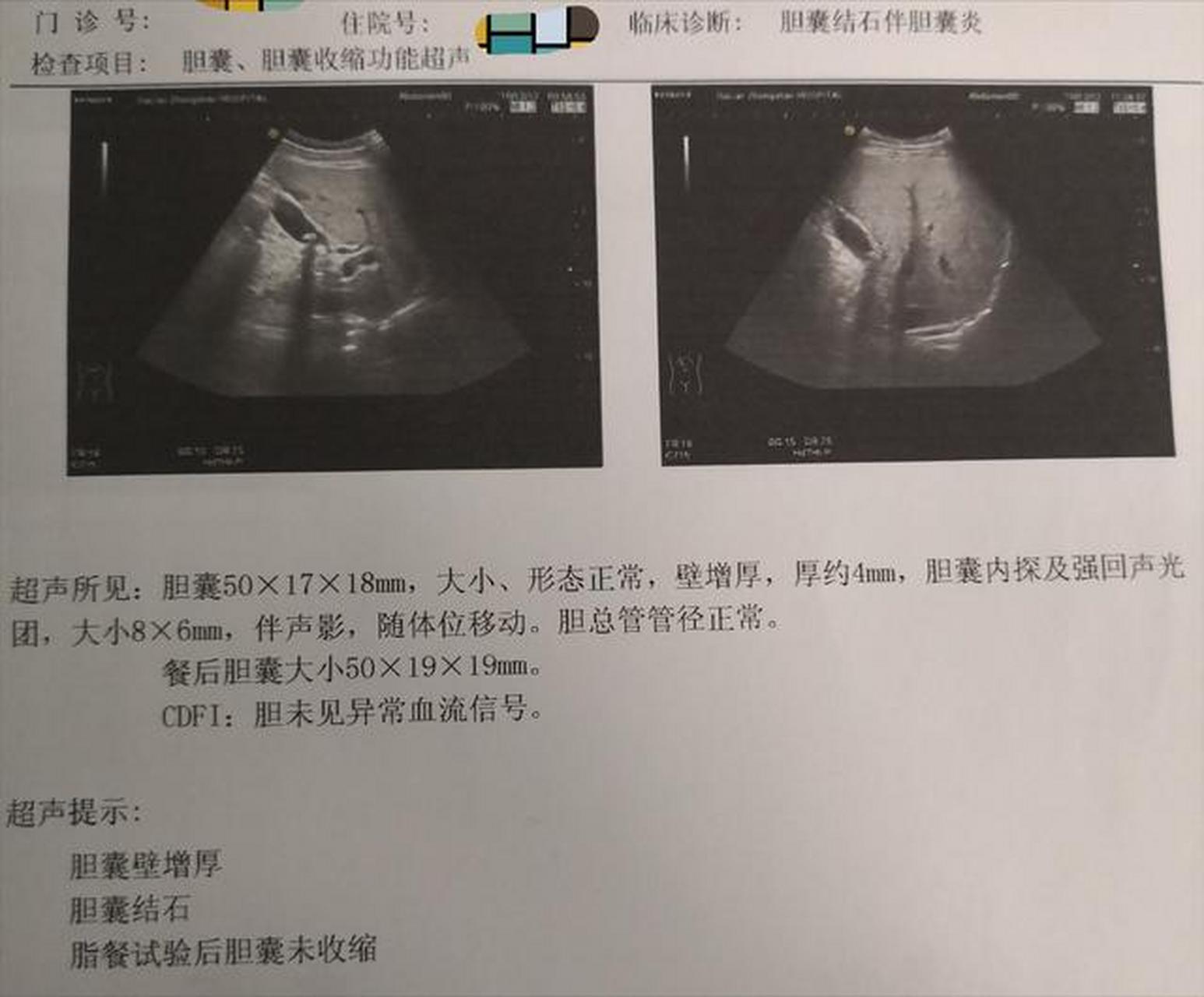 胆结石彩超图片