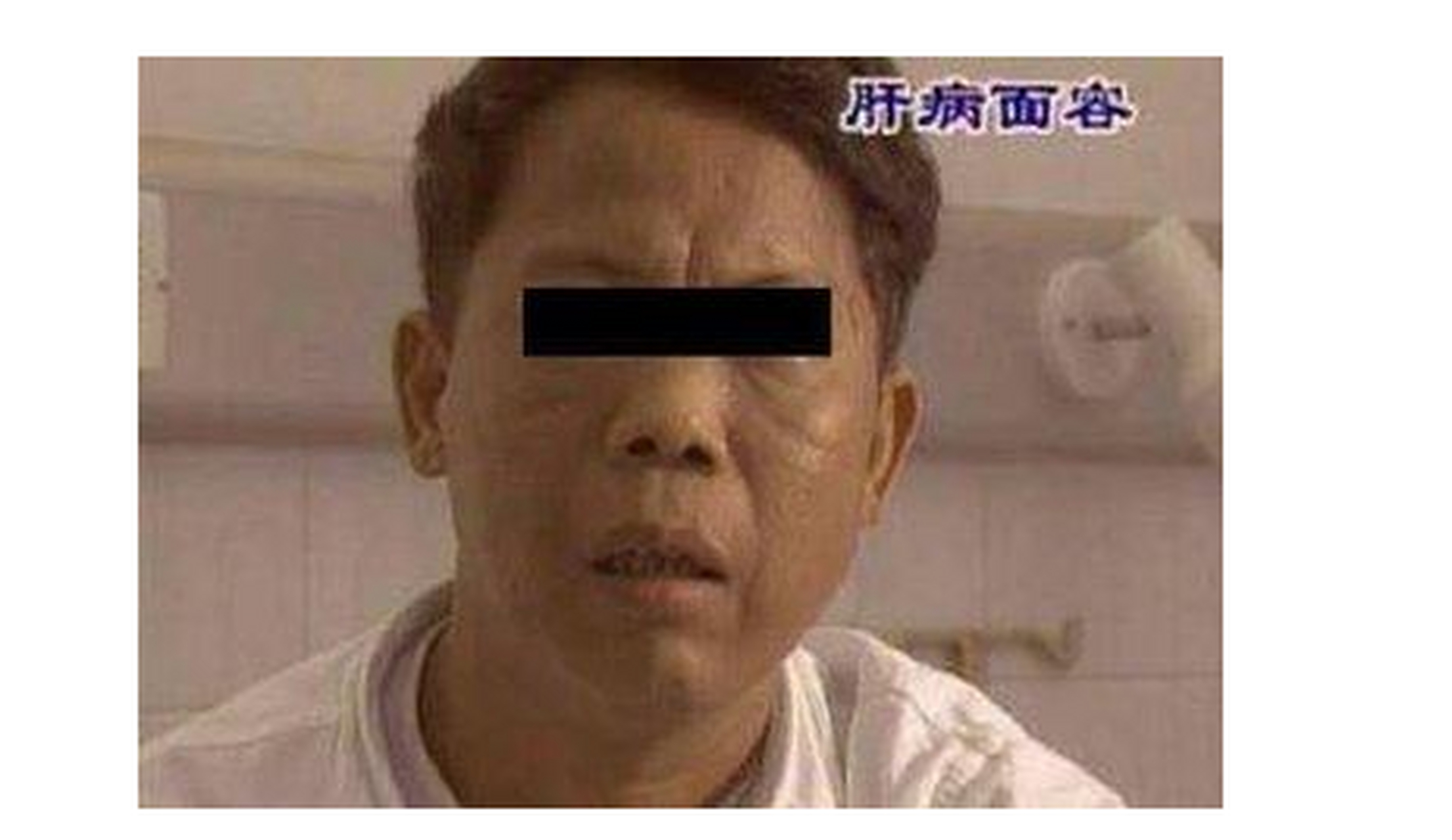 面无光泽,有可能你是肝病面容】肝病面容是指慢性肝病,尤其是肝硬化的