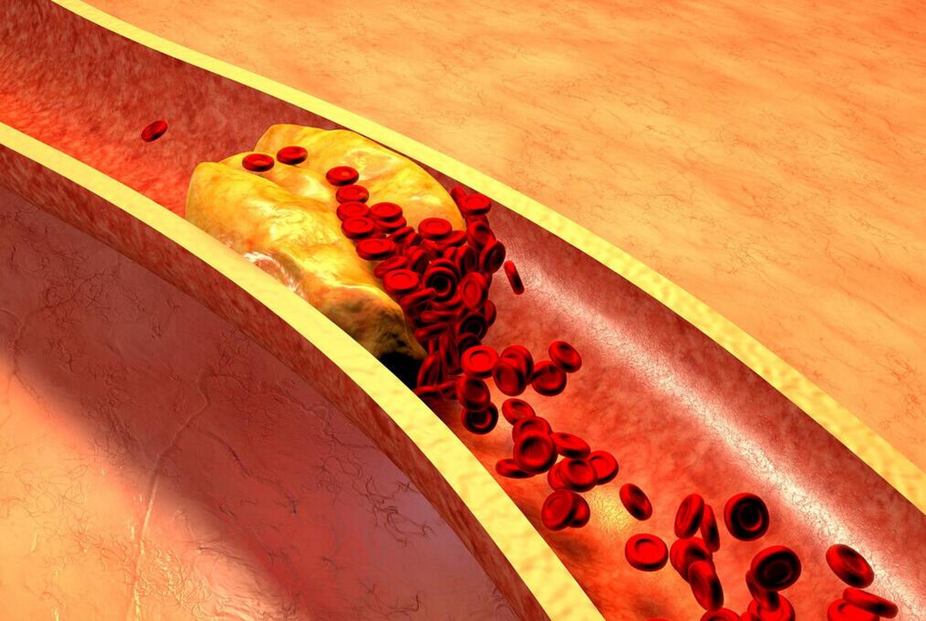水里煮四物,冲开血管淤堵,溶解全身血淤 去年5月份看诊的一位患者,就