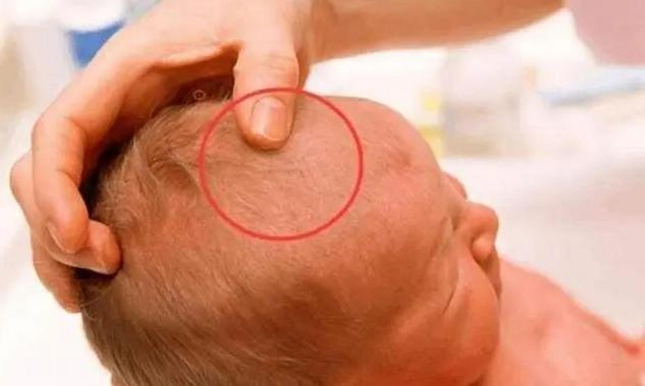 狭颅症:也可以称为颅缝早闭,颅骨的发育异常限制了