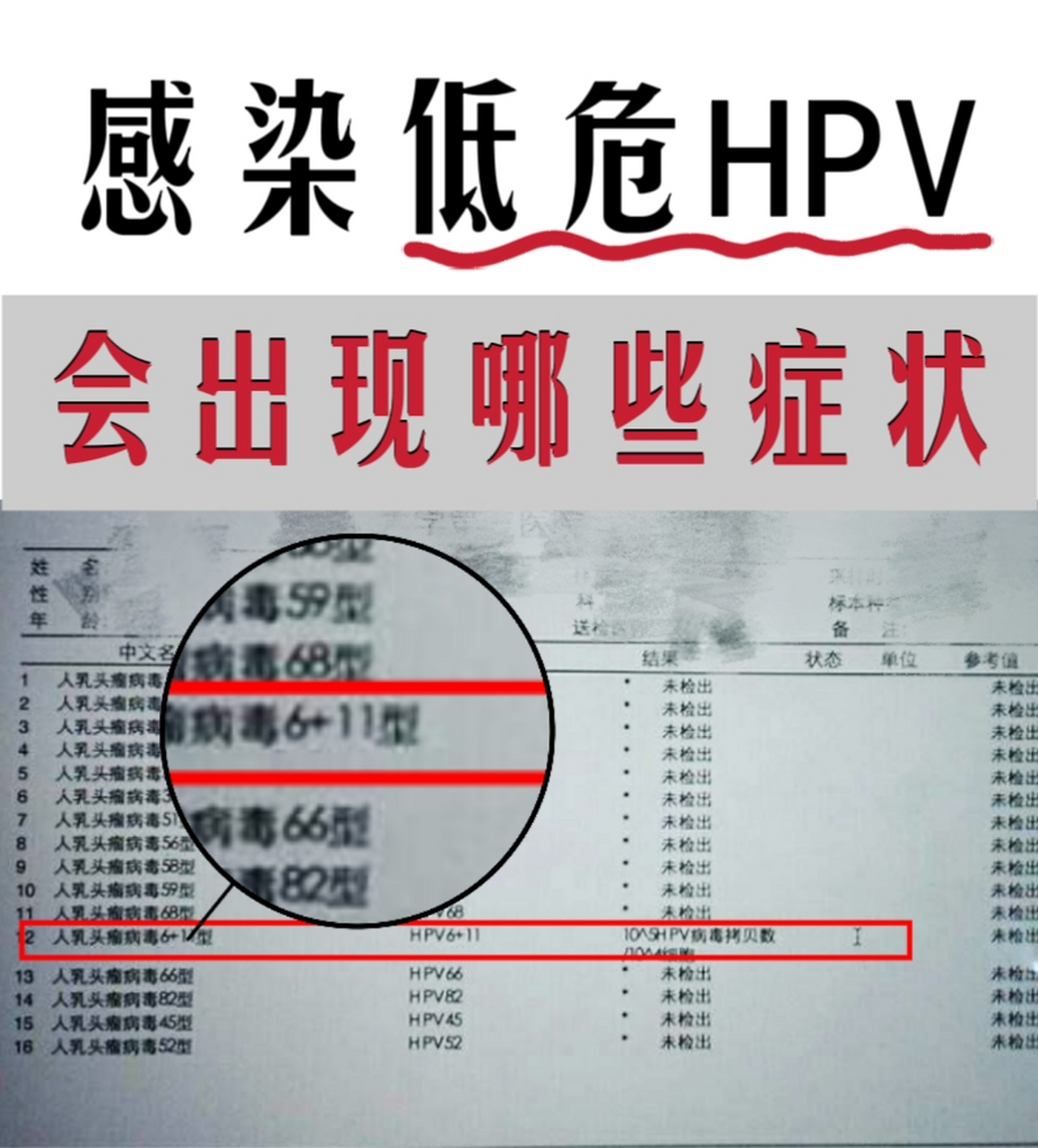 感染低危hpv都有哪些症狀?