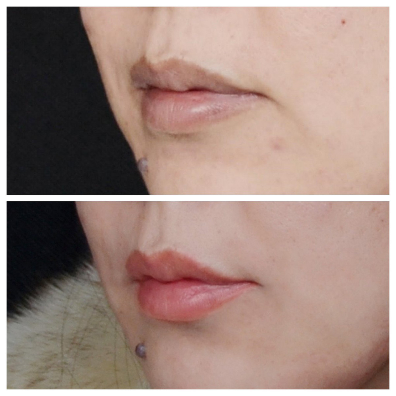 玻尿酸丰唇#  有唇形并且饱满的嘴巴 确实很好看