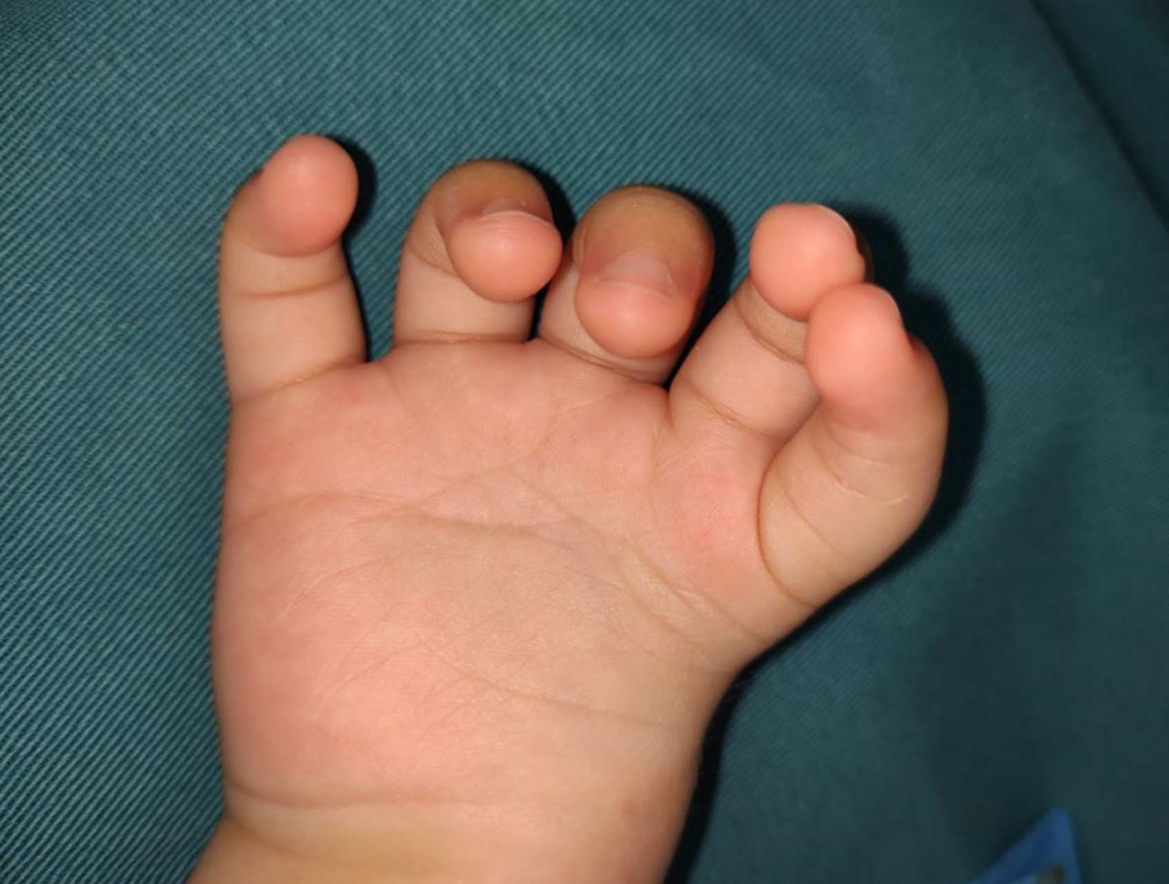 镜影手看似多了手指,但其实没有拇指功能 前段时间有一个家长咨询,他